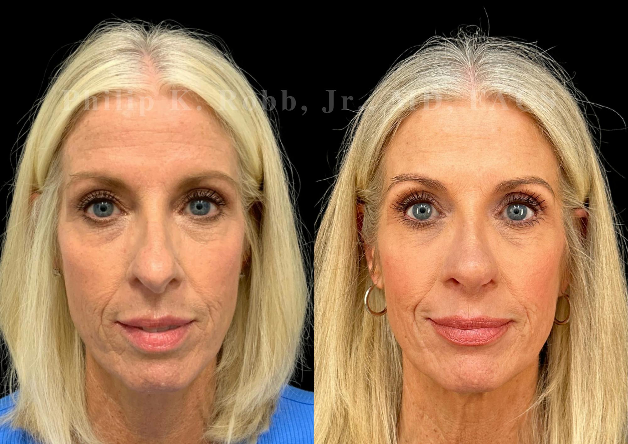 Laser Skin Resurfacing Before & After Gallery - Patient 409282 - Image 1
