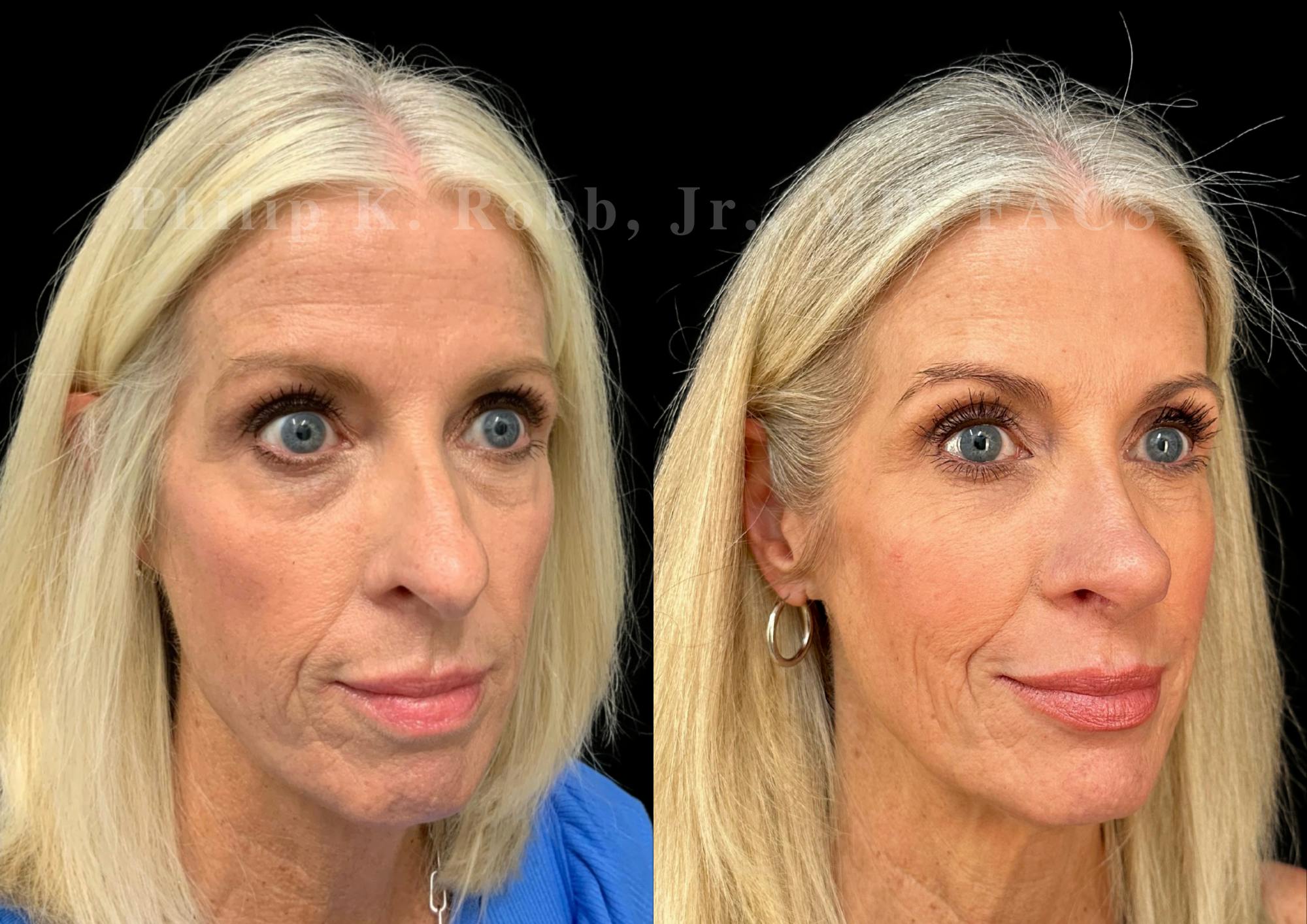 Laser Skin Resurfacing Before & After Gallery - Patient 409282 - Image 4