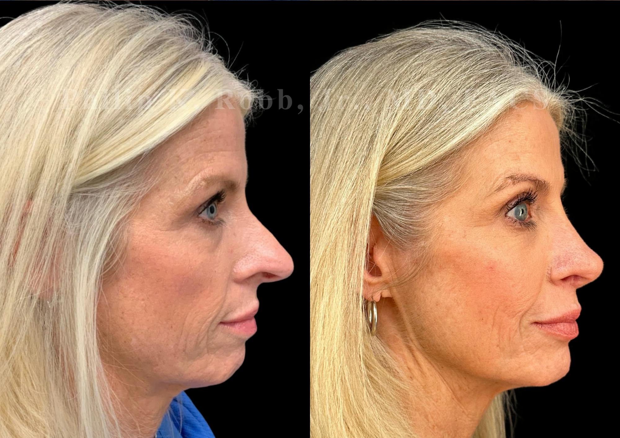 Laser Skin Resurfacing Before & After Gallery - Patient 409282 - Image 5