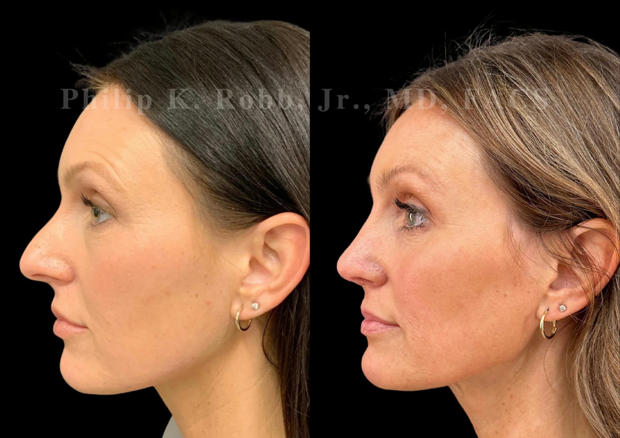 Fat Transfer Before & After Gallery - Patient 402713 - Image 2