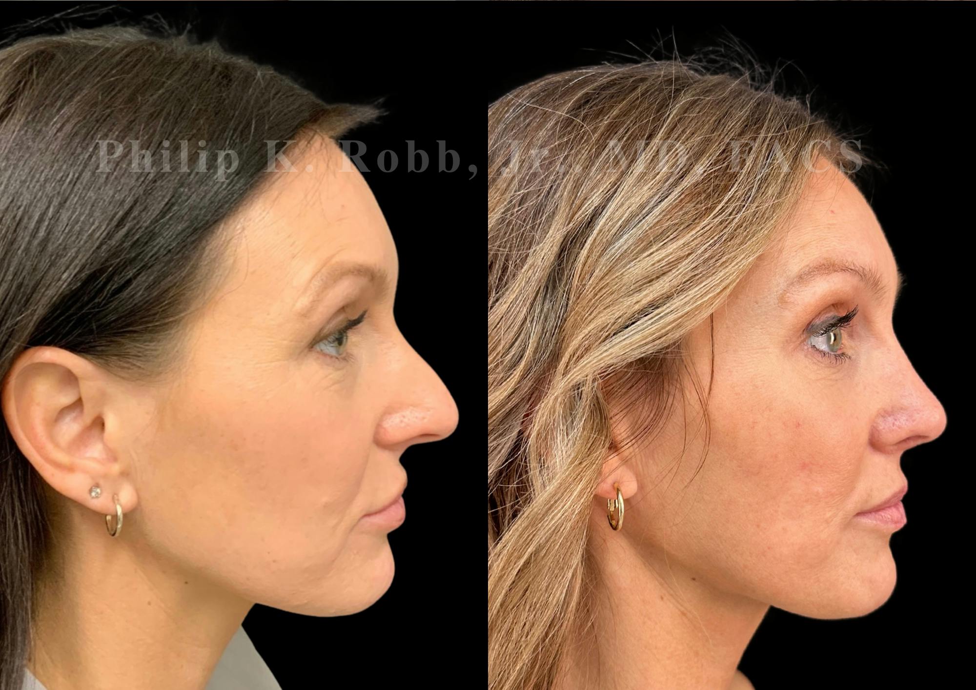 Fat Transfer Before & After Gallery - Patient 402713 - Image 5