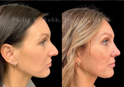 Ultrasonic Rhinoplasty Before & After Gallery - Patient 164380 - Image 1