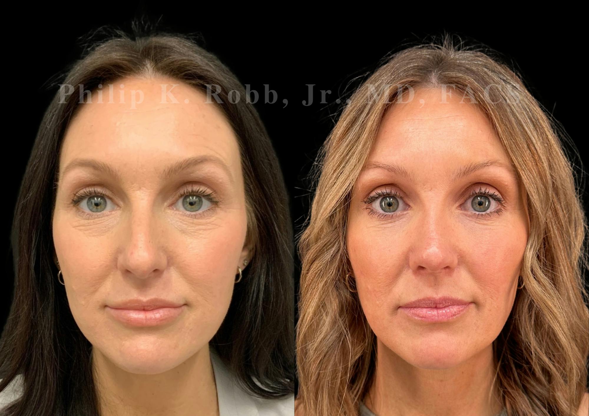 Fat Transfer Before & After Gallery - Patient 402713 - Image 1