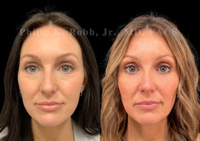 Laser Skin Resurfacing Before & After Gallery - Patient 210669 - Image 1