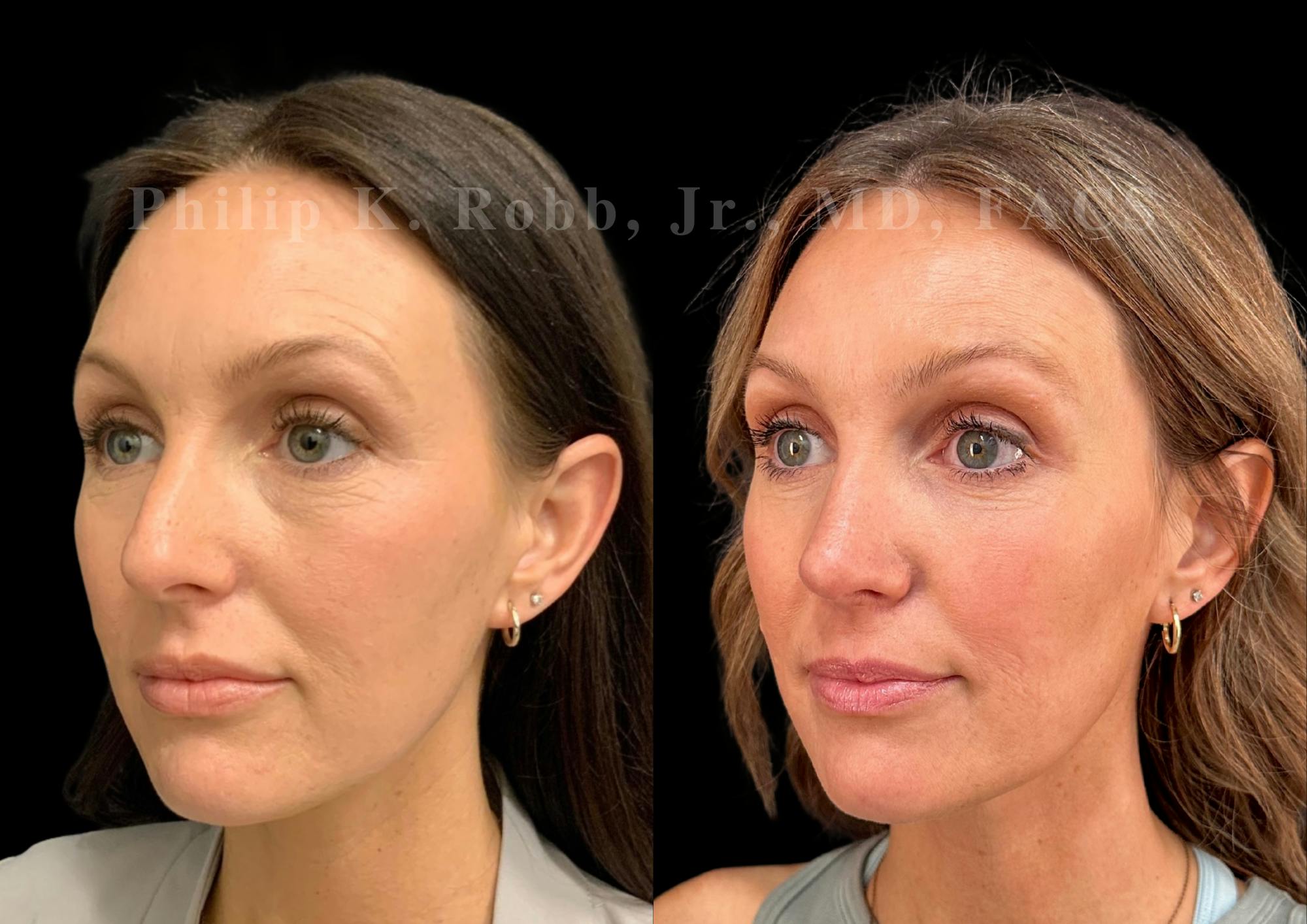 Fat Transfer Before & After Gallery - Patient 402713 - Image 3