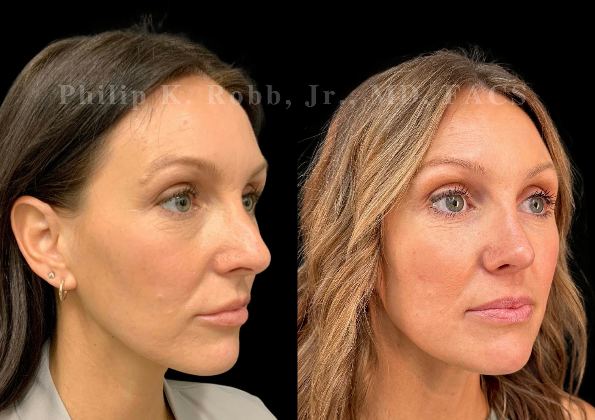 Fat Transfer Before & After Gallery - Patient 402713 - Image 4