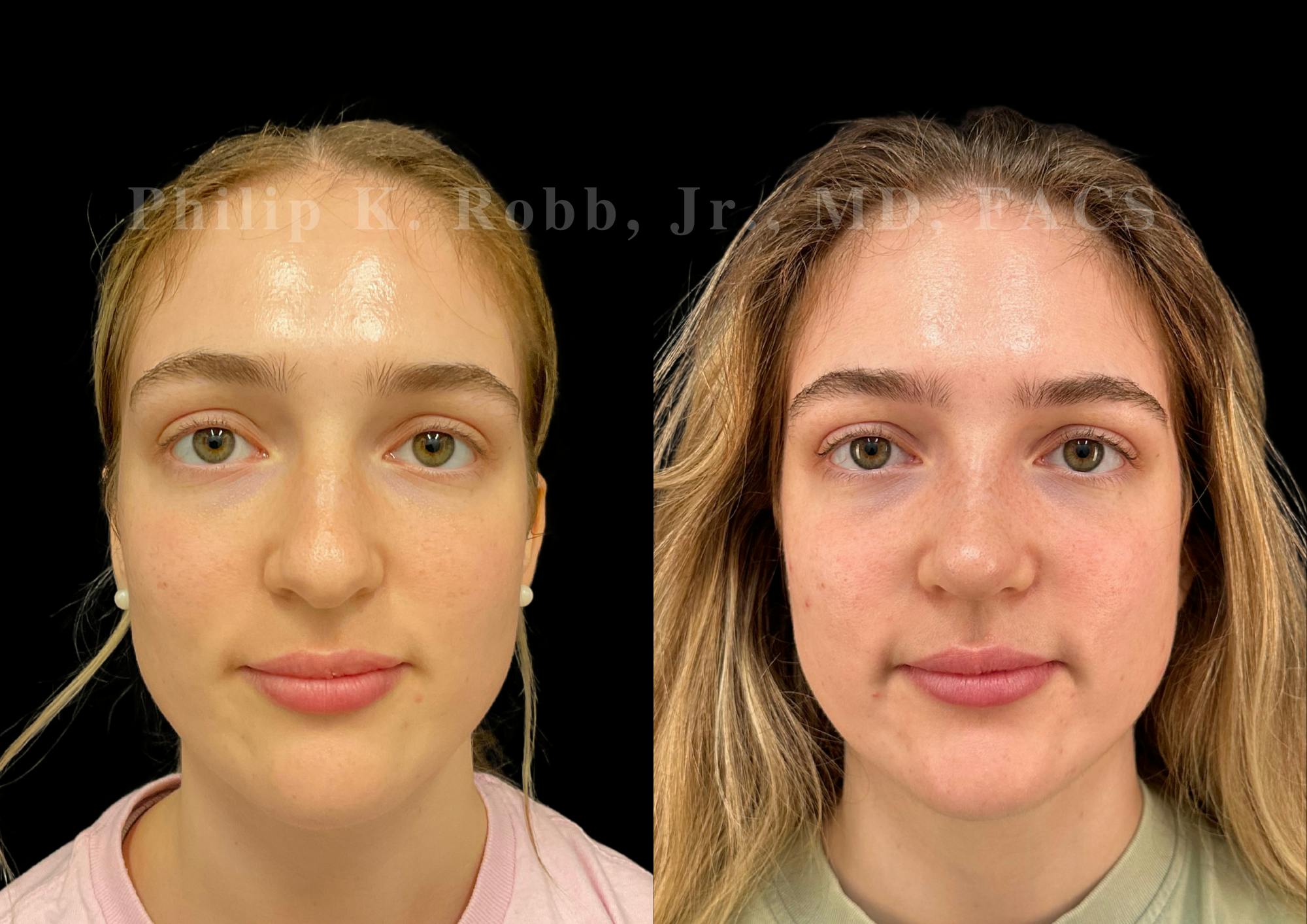 Ultrasonic Rhinoplasty Before & After Gallery - Patient 278768 - Image 3