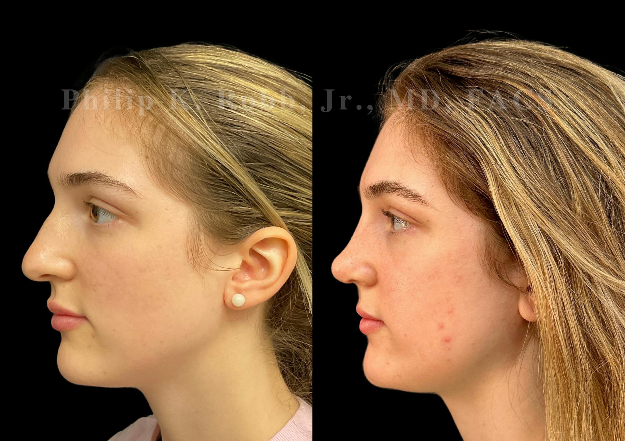 Ultrasonic Rhinoplasty Before & After Gallery - Patient 278768 - Image 5