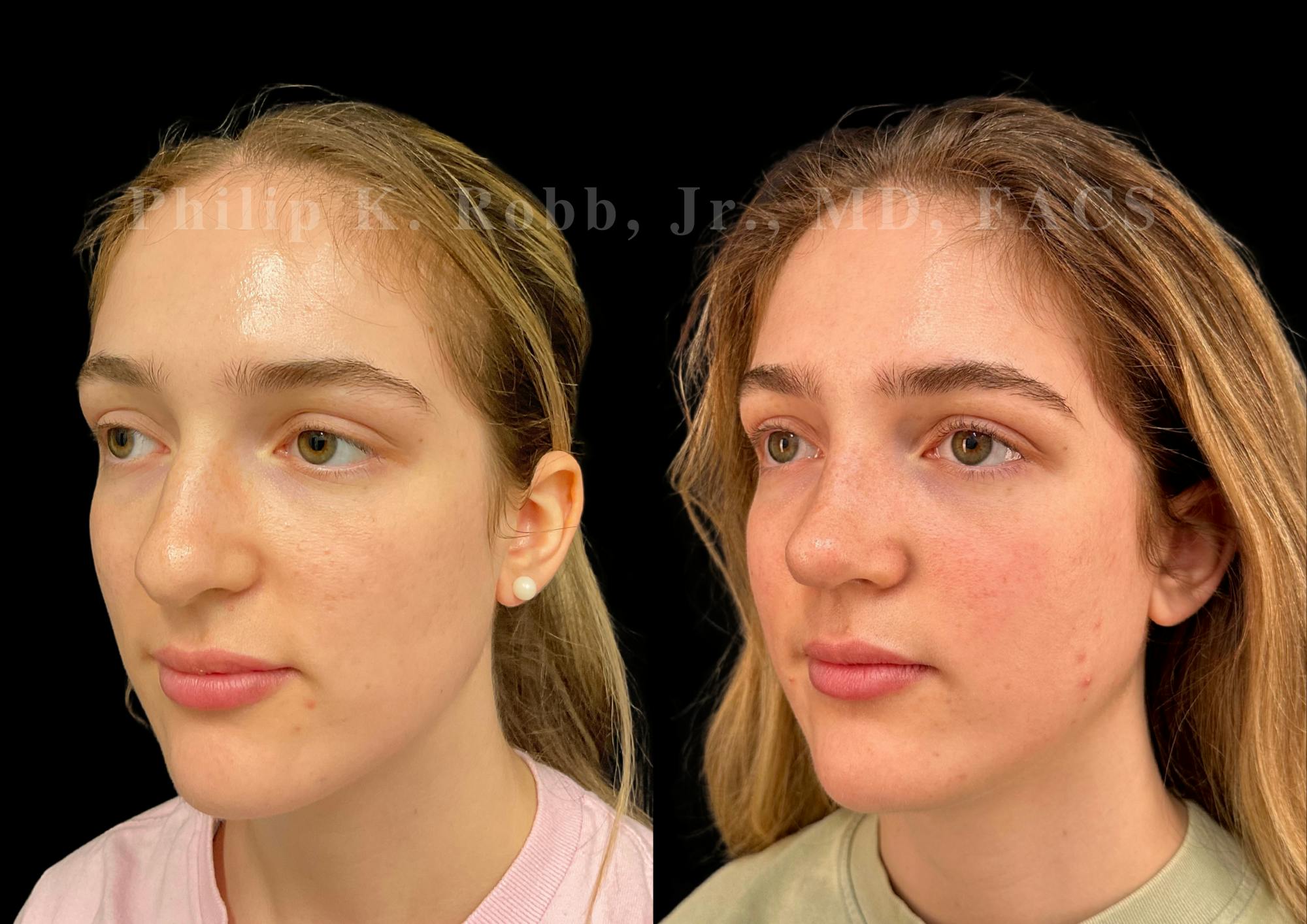 Ultrasonic Rhinoplasty Before & After Gallery - Patient 278768 - Image 4