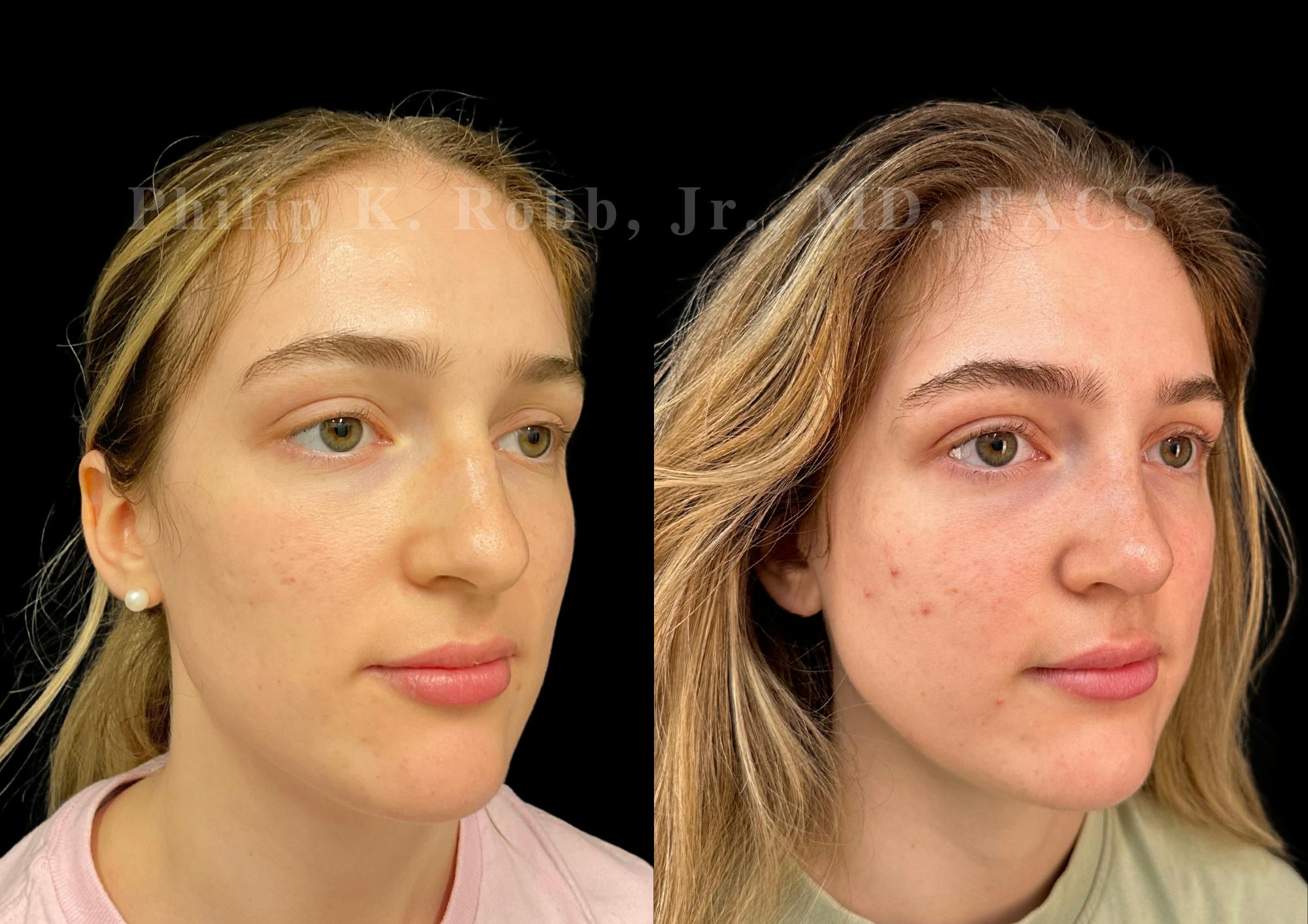 Ultrasonic Rhinoplasty Before & After Gallery - Patient 278768 - Image 2