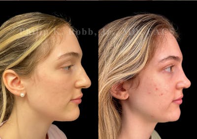 Ultrasonic Rhinoplasty Before & After Gallery - Patient 278768 - Image 1