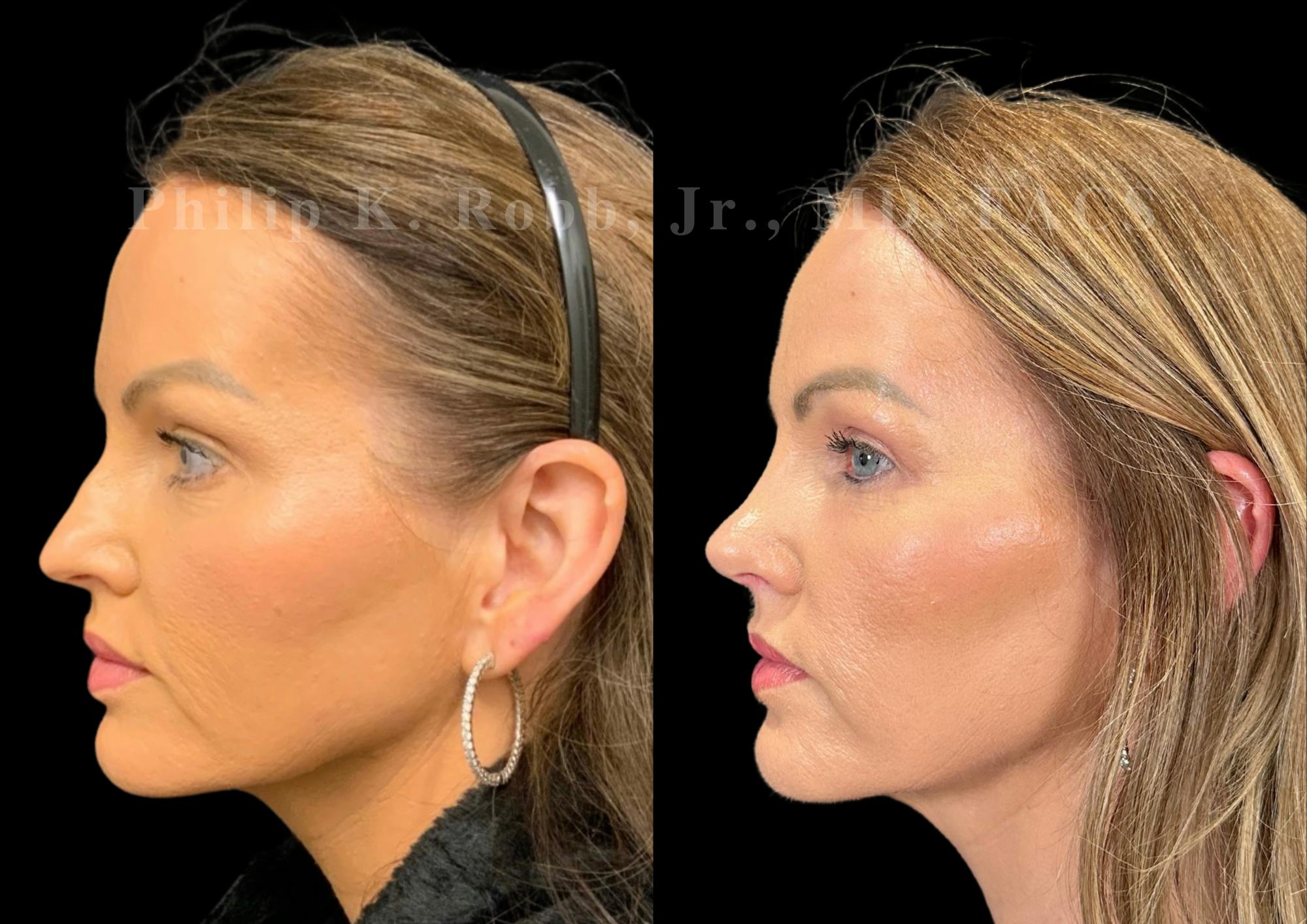 Ultrasonic Rhinoplasty Before & After Gallery - Patient 377793 - Image 5