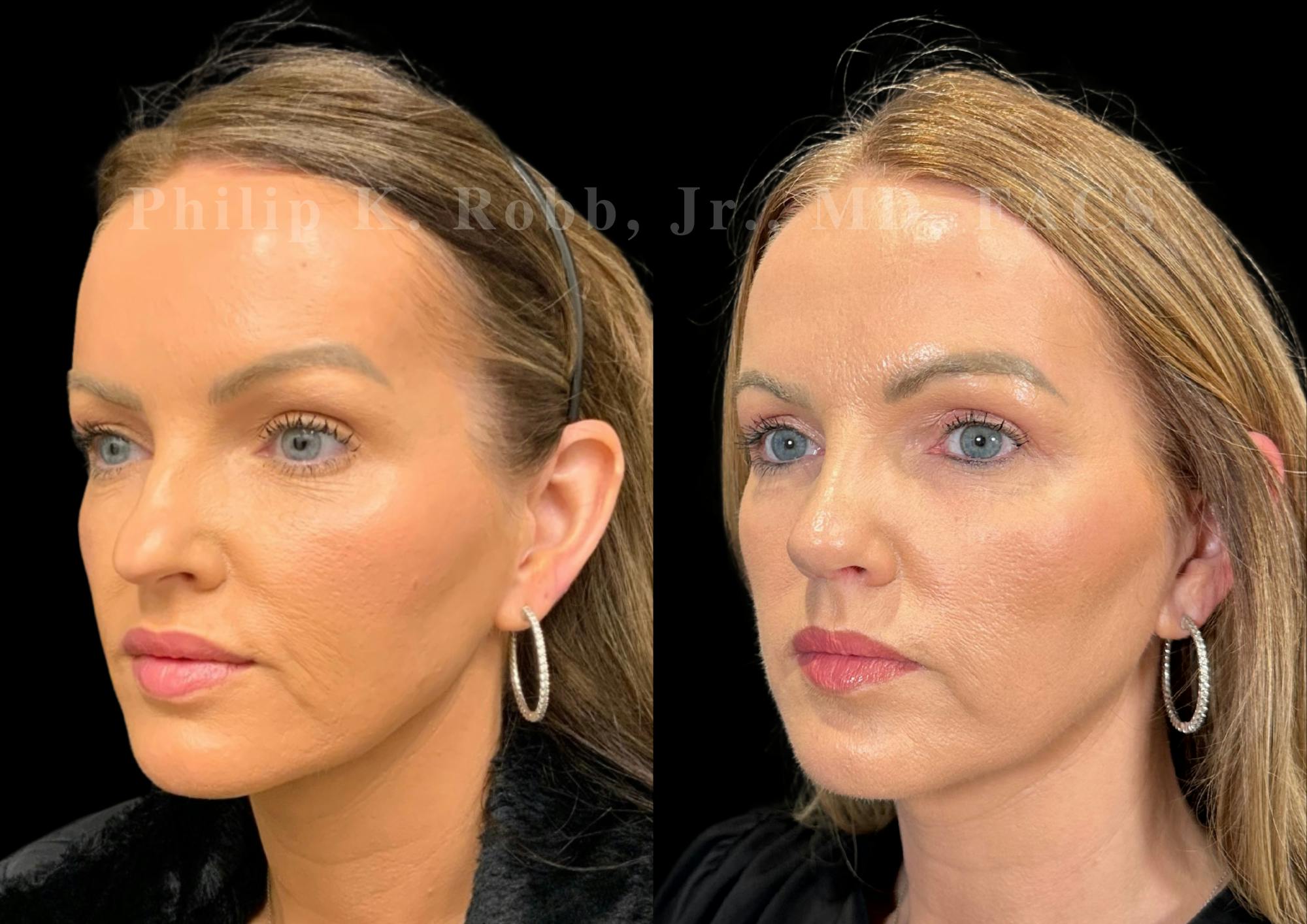 Ultrasonic Rhinoplasty Before & After Gallery - Patient 377793 - Image 4