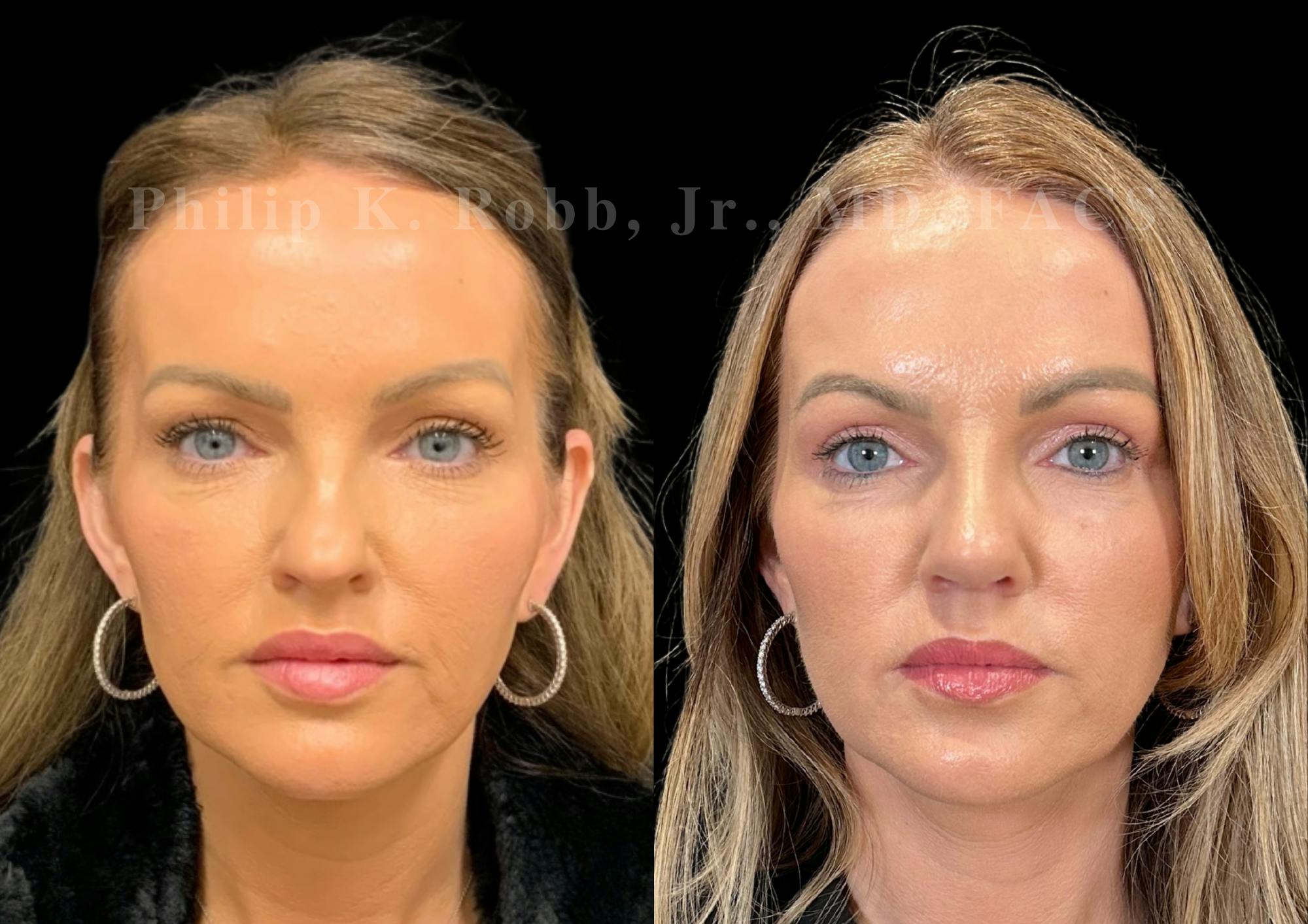 Ultrasonic Rhinoplasty Before & After Gallery - Patient 377793 - Image 3