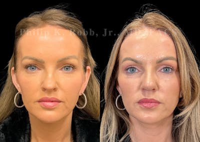 Laser Skin Resurfacing Before & After Gallery - Patient 106695 - Image 1