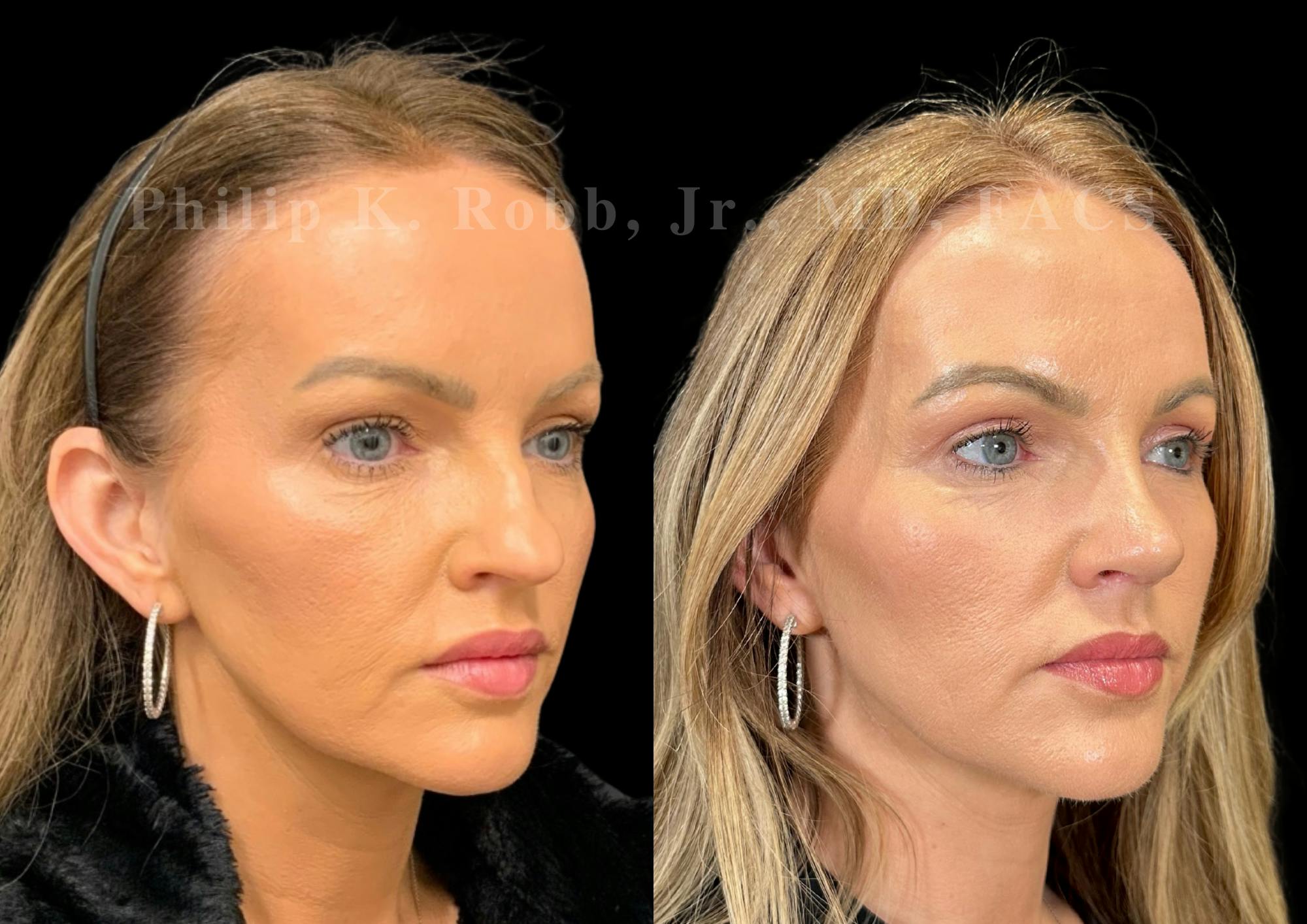 Ultrasonic Rhinoplasty Before & After Gallery - Patient 377793 - Image 2