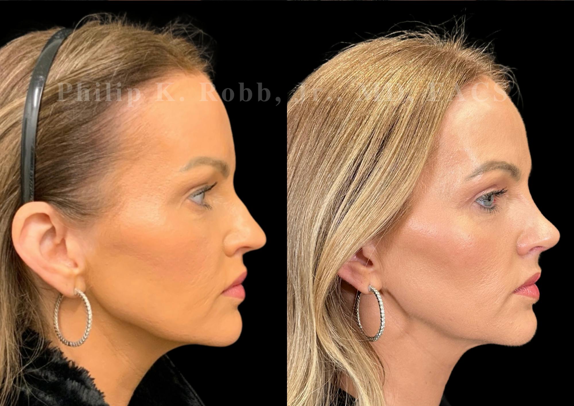 Ultrasonic Rhinoplasty Before & After Gallery - Patient 377793 - Image 1