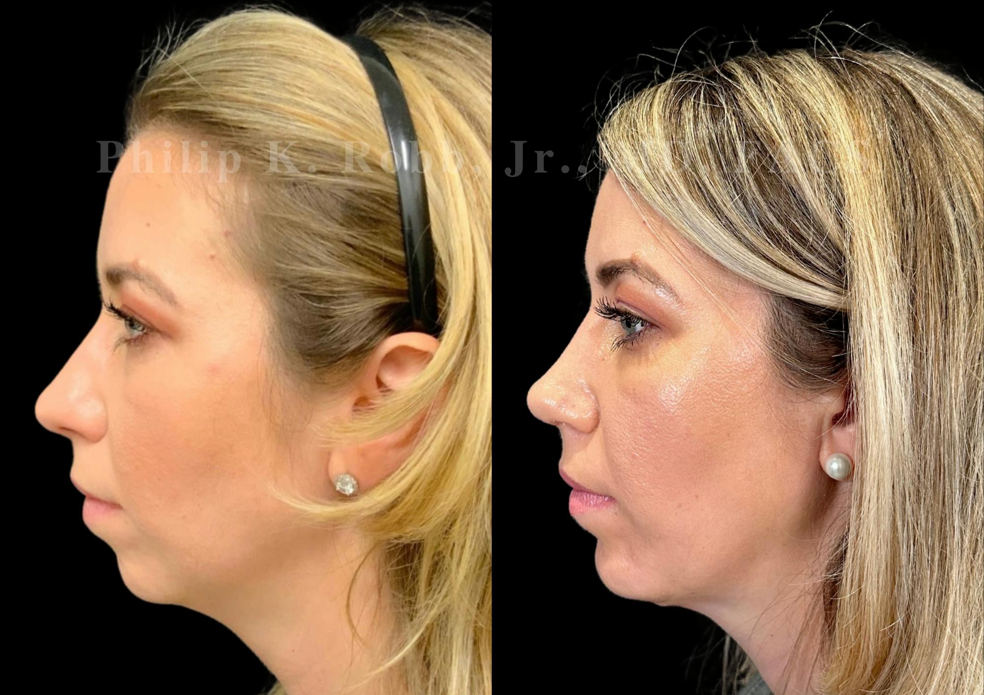 Chin Augmentation Before & After Gallery - Patient 384199 - Image 1