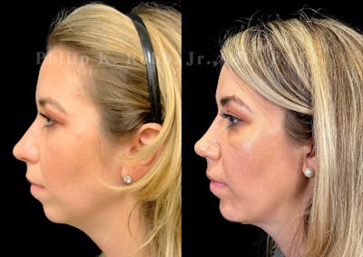 Chin Augmentation Before & After Gallery - Patient 384199 - Image 1