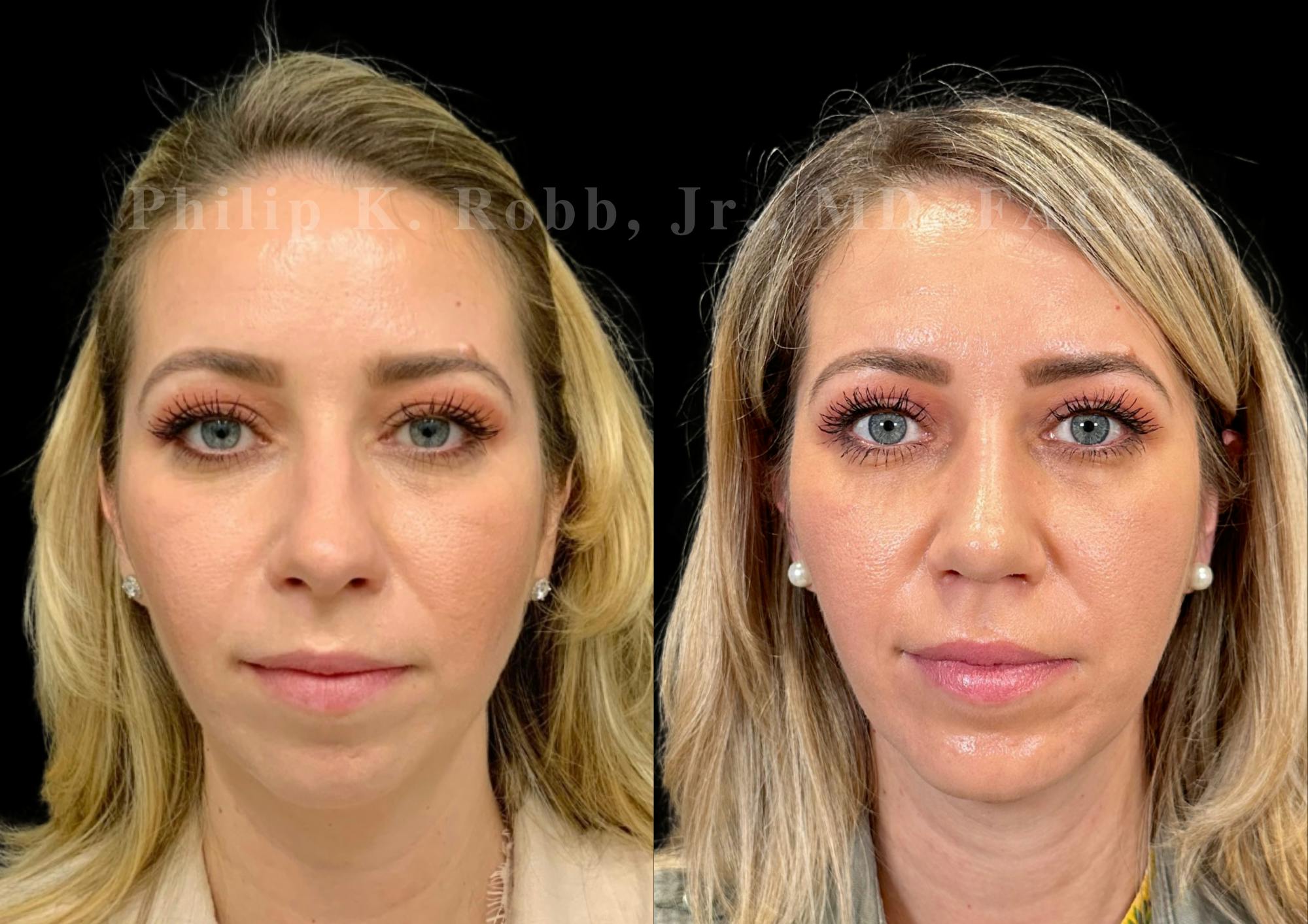 Chin Augmentation Before & After Gallery - Patient 384199 - Image 3