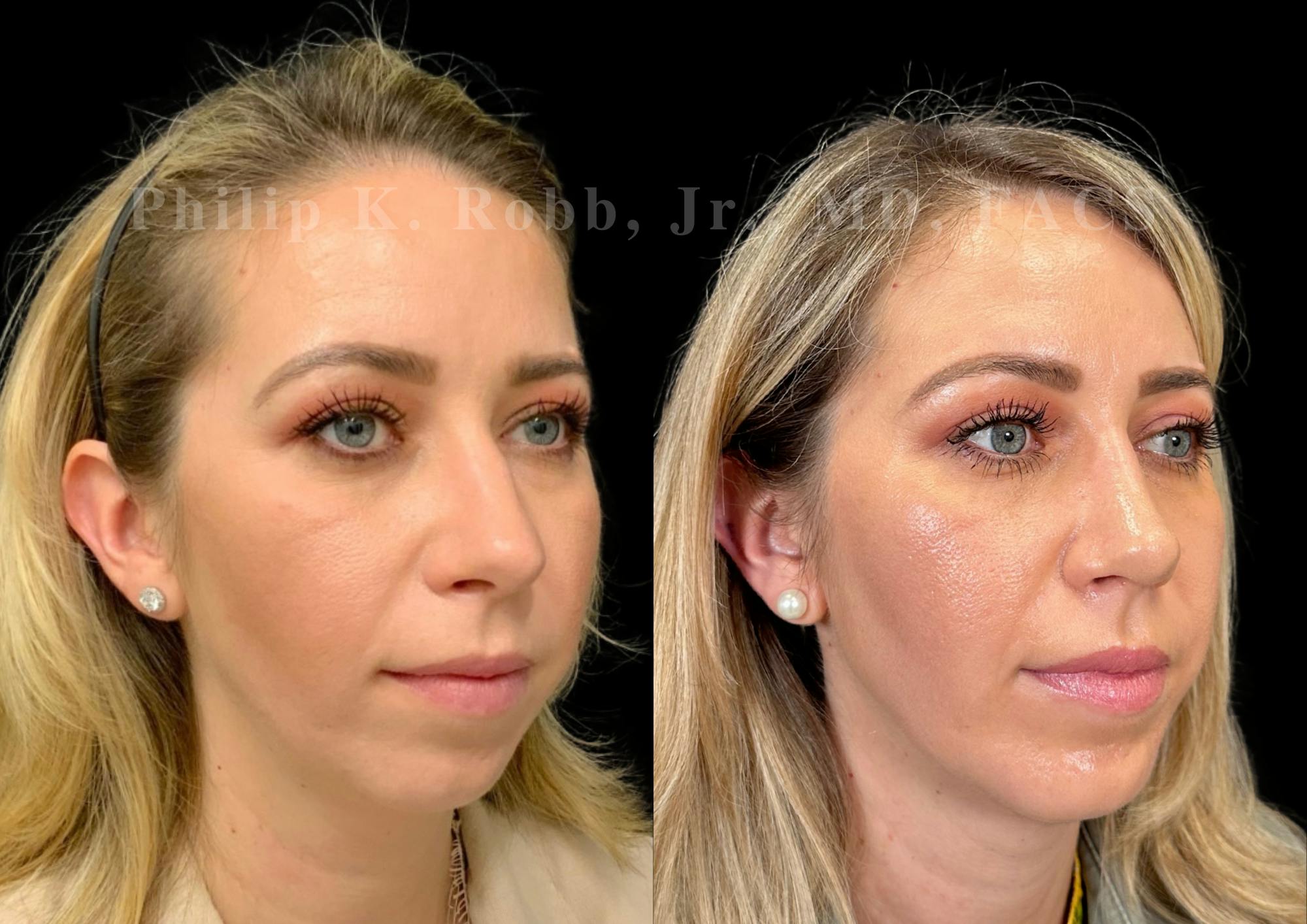 Chin Augmentation Before & After Gallery - Patient 384199 - Image 4