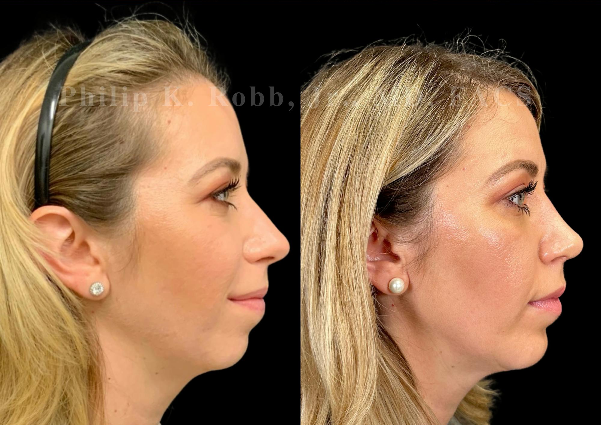 Chin Augmentation Before & After Gallery - Patient 384199 - Image 5