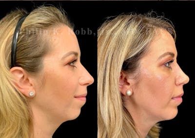 Ultrasonic Rhinoplasty Before & After Gallery - Patient 211479 - Image 1