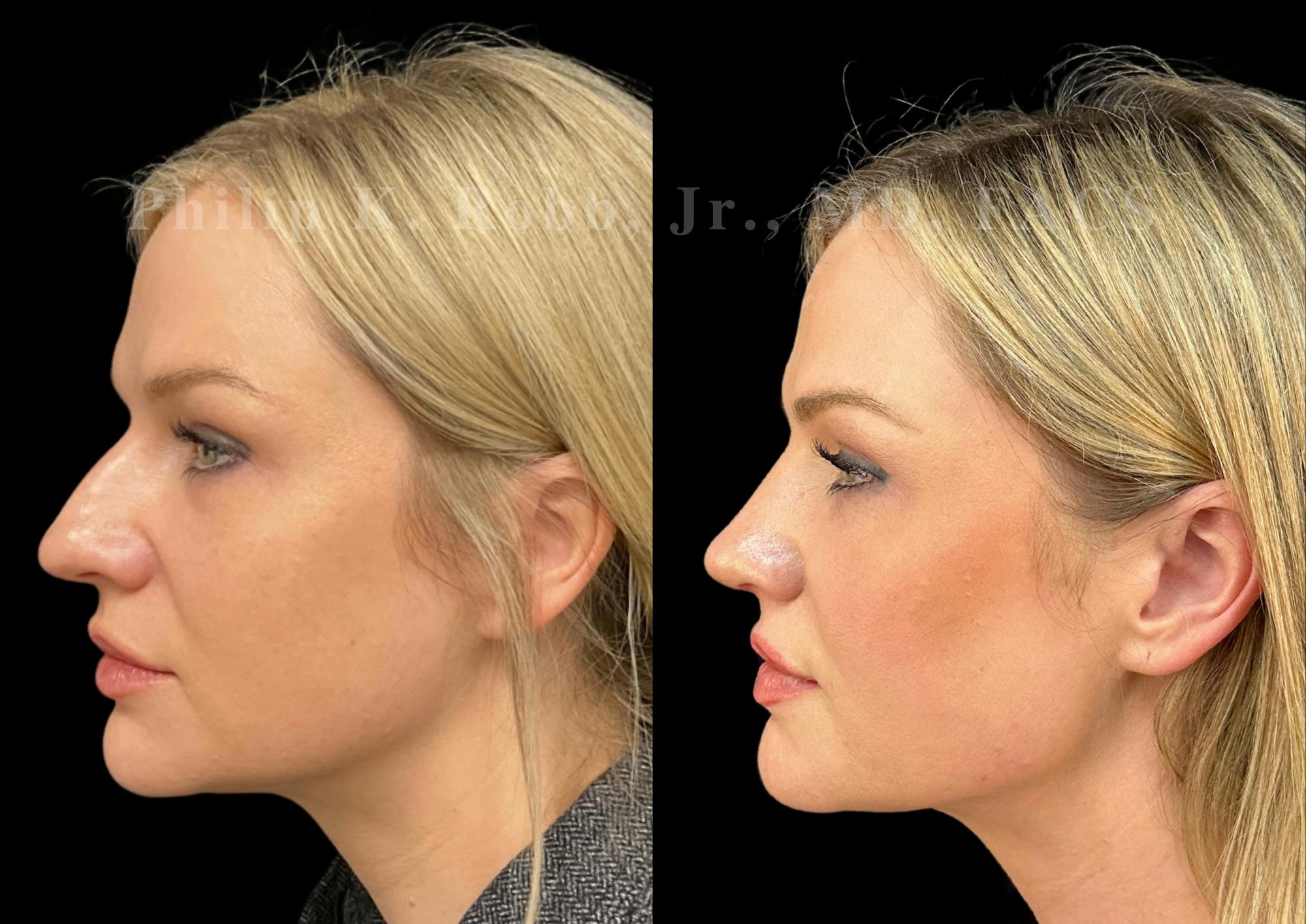 Fat Transfer Before & After Gallery - Patient 190944 - Image 2