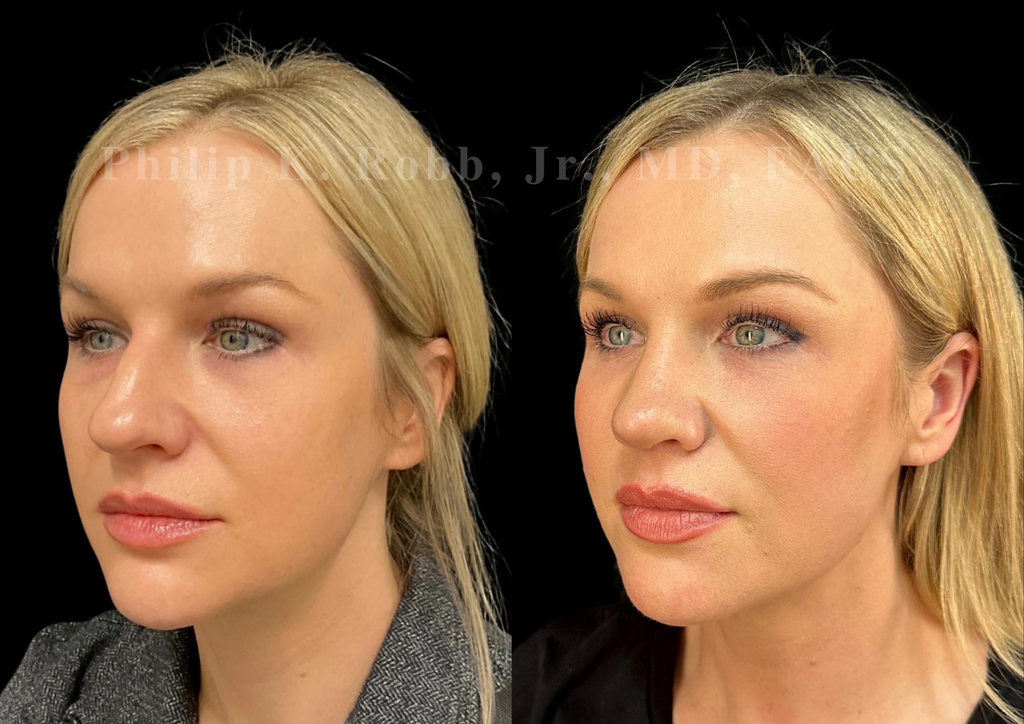 Fat Transfer Before & After Gallery - Patient 190944 - Image 3