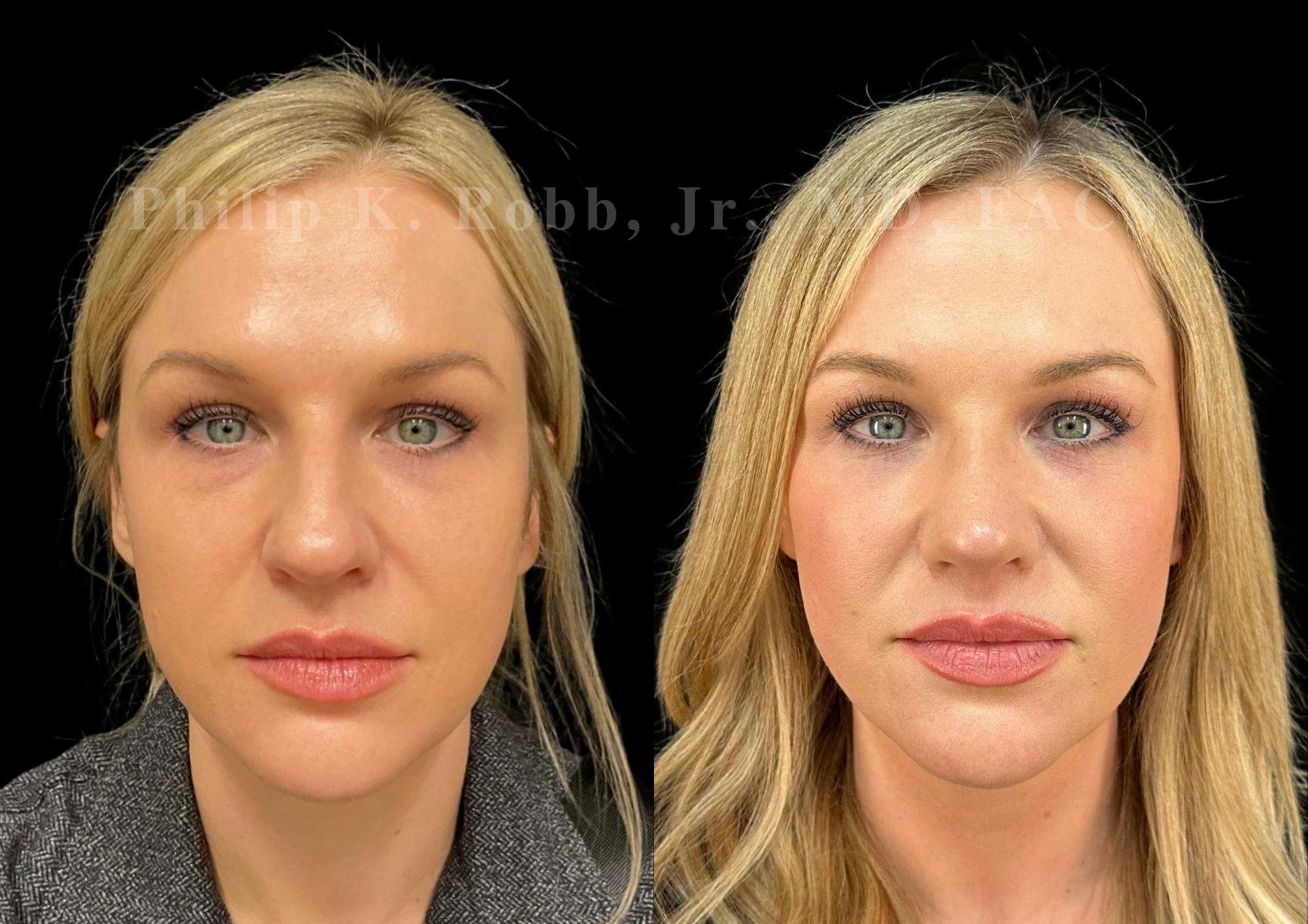 Fat Transfer Before & After Gallery - Patient 190944 - Image 1