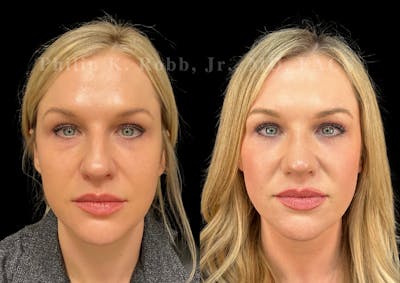 Laser Skin Resurfacing Before & After Gallery - Patient 311368 - Image 1