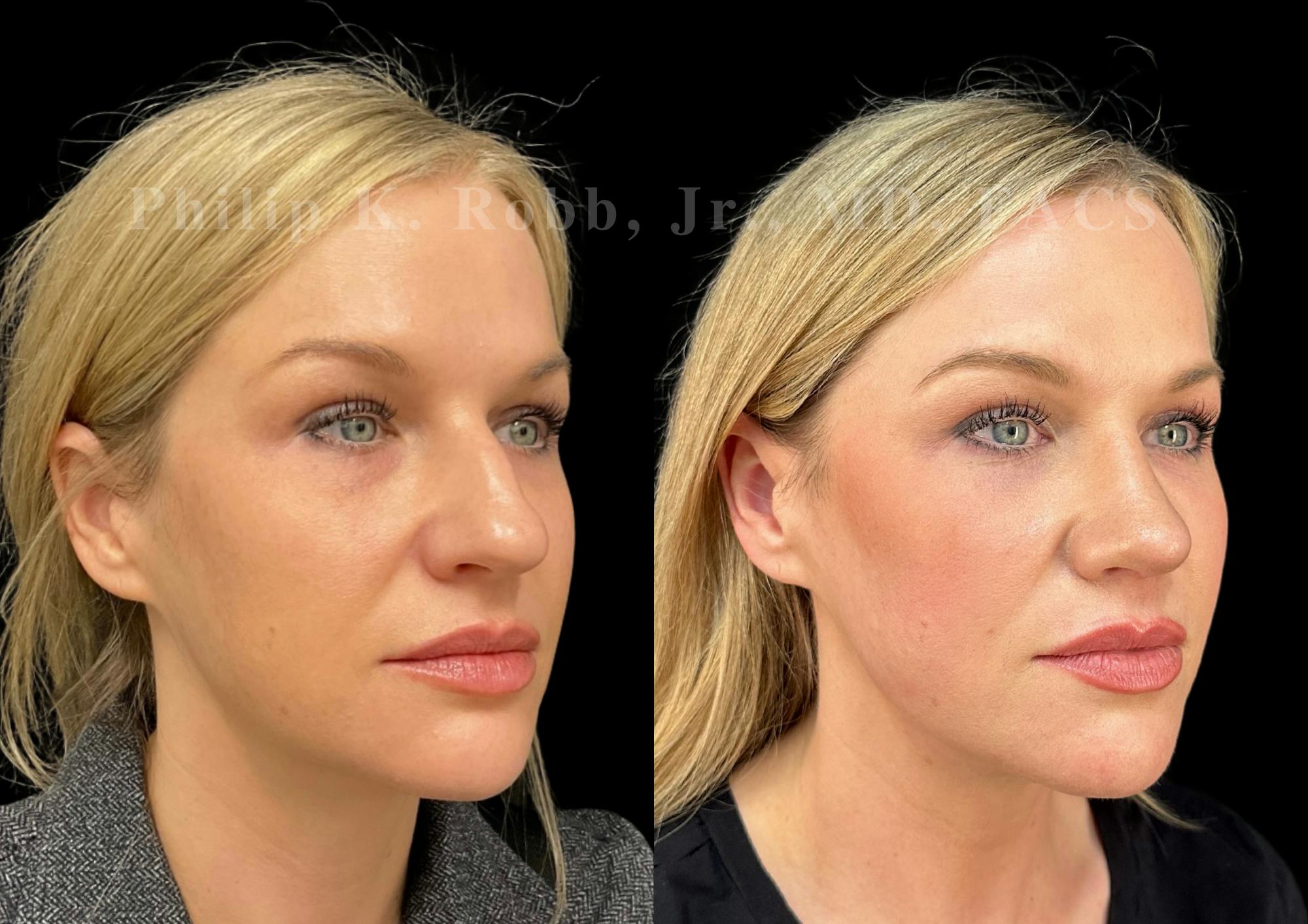 Fat Transfer Before & After Gallery - Patient 190944 - Image 4