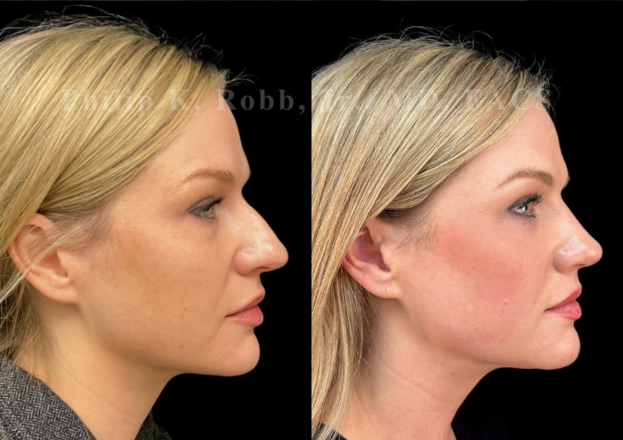 Fat Transfer Before & After Gallery - Patient 190944 - Image 5