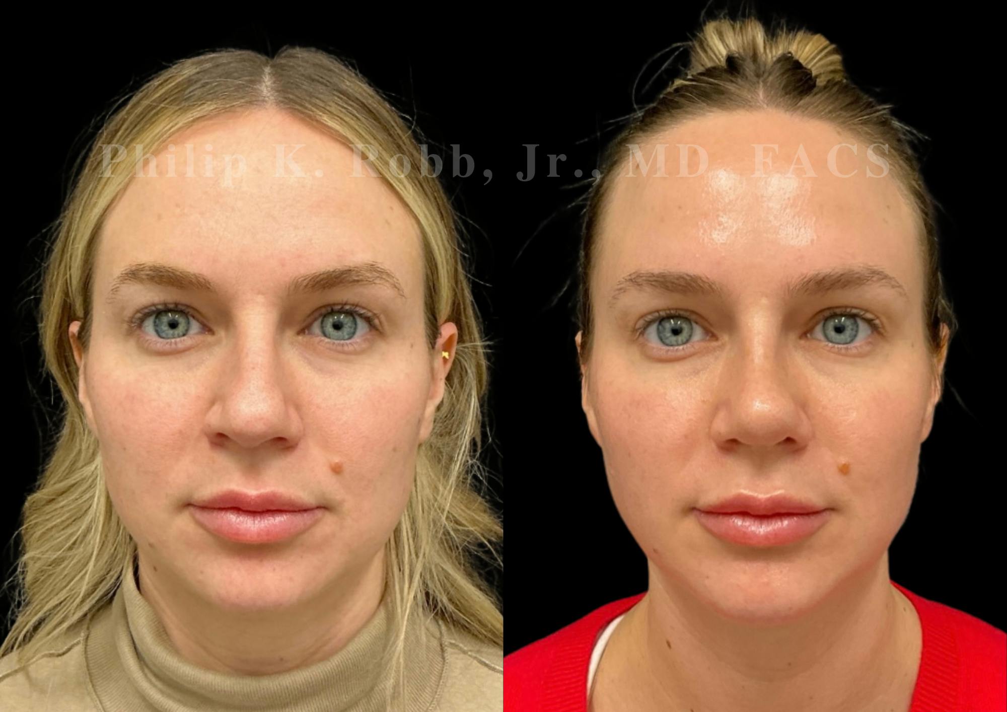 Chin Augmentation Before & After Gallery - Patient 168920 - Image 3