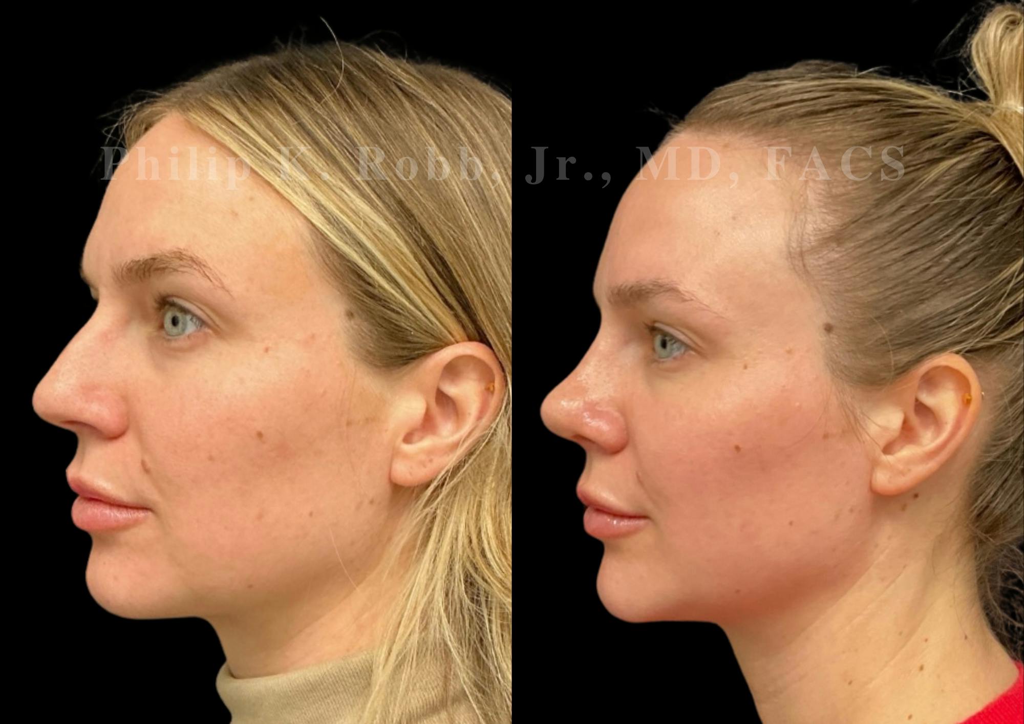 Chin Augmentation Before & After Gallery - Patient 168920 - Image 1
