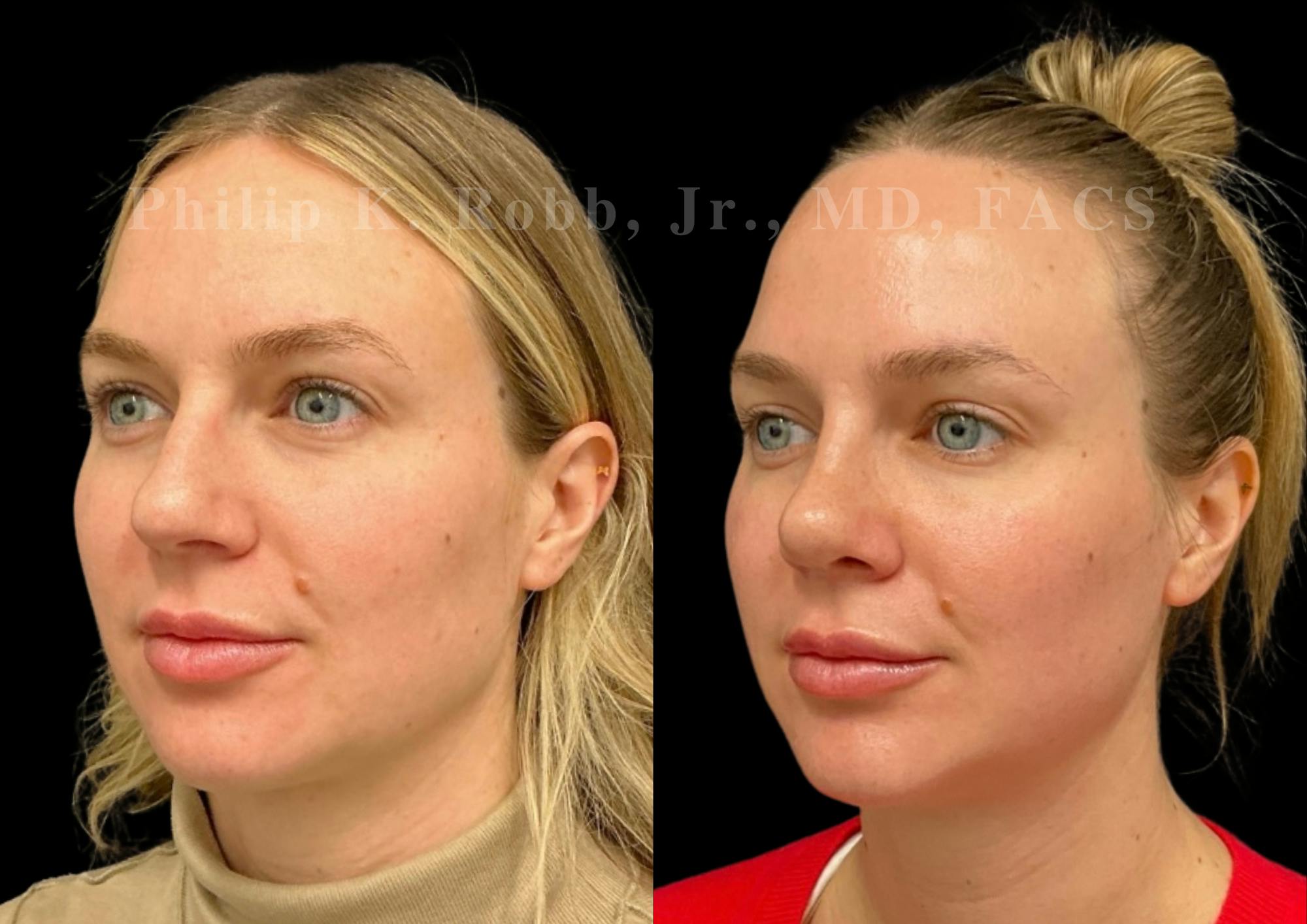 Chin Augmentation Before & After Gallery - Patient 168920 - Image 2