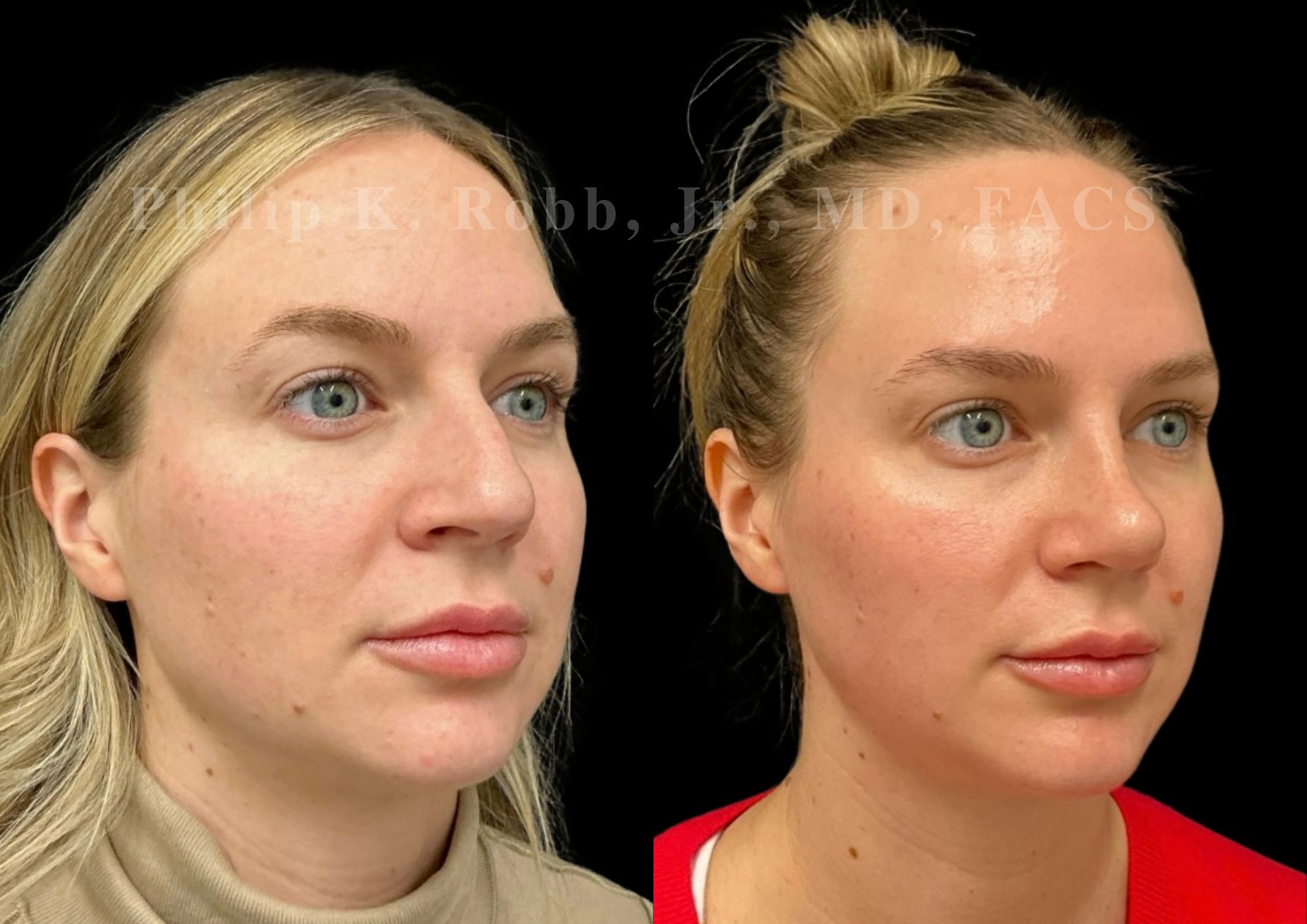 Chin Augmentation Before & After Gallery - Patient 168920 - Image 4