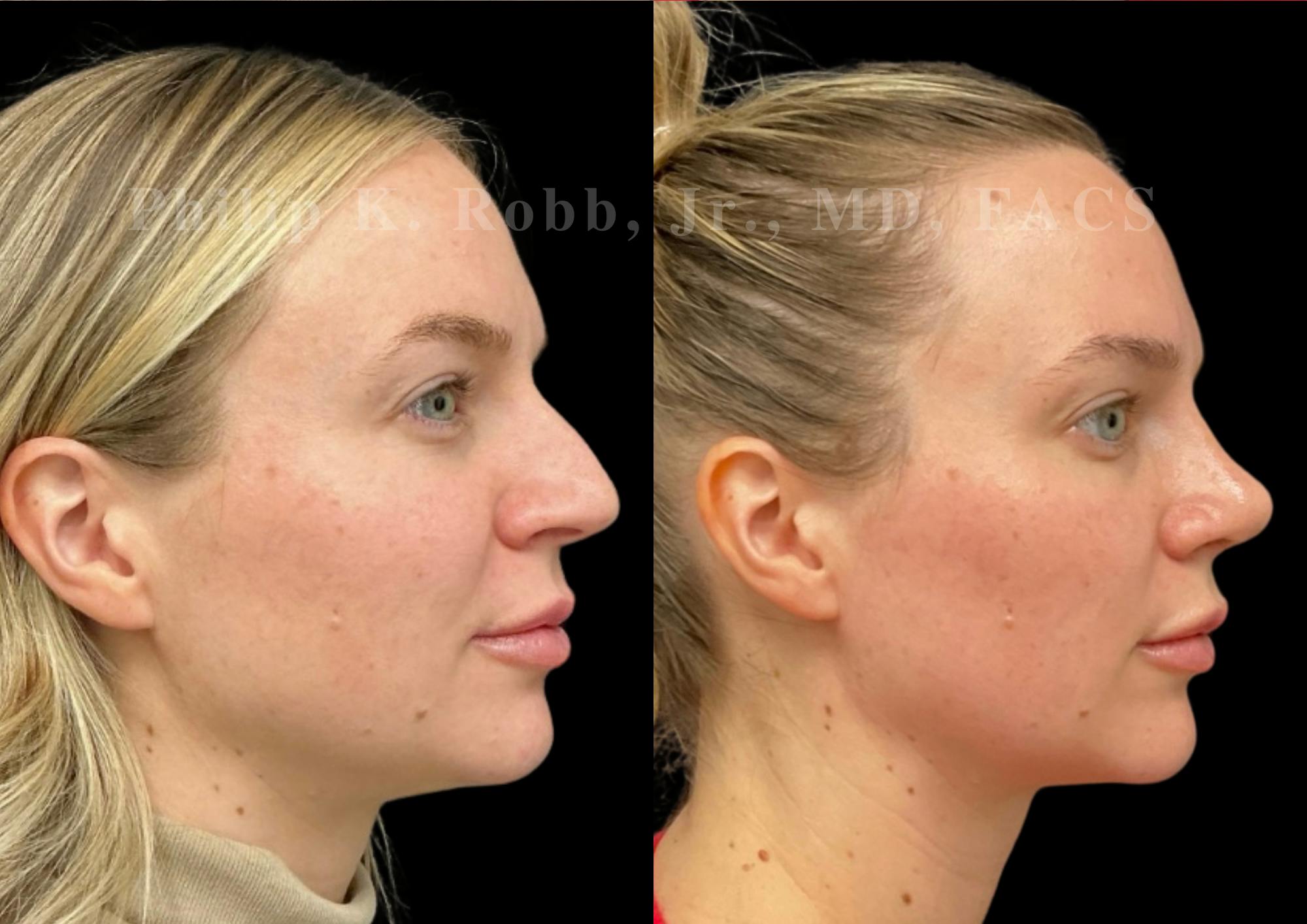 Chin Augmentation Before & After Gallery - Patient 168920 - Image 5
