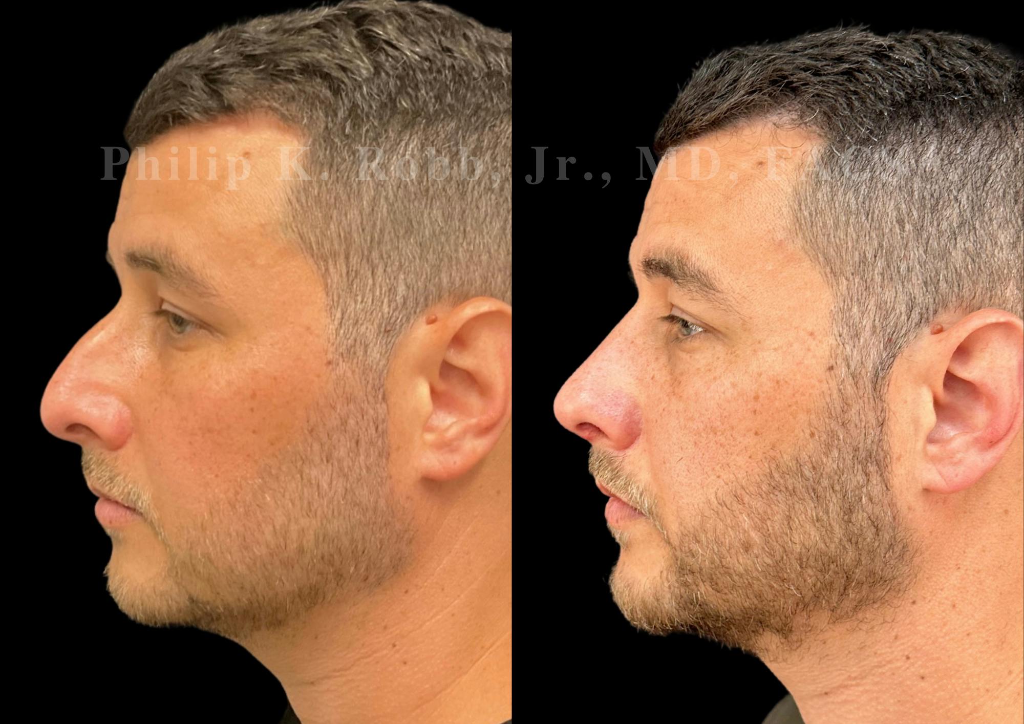 Ultrasonic Rhinoplasty Before & After Gallery - Patient 406620 - Image 5