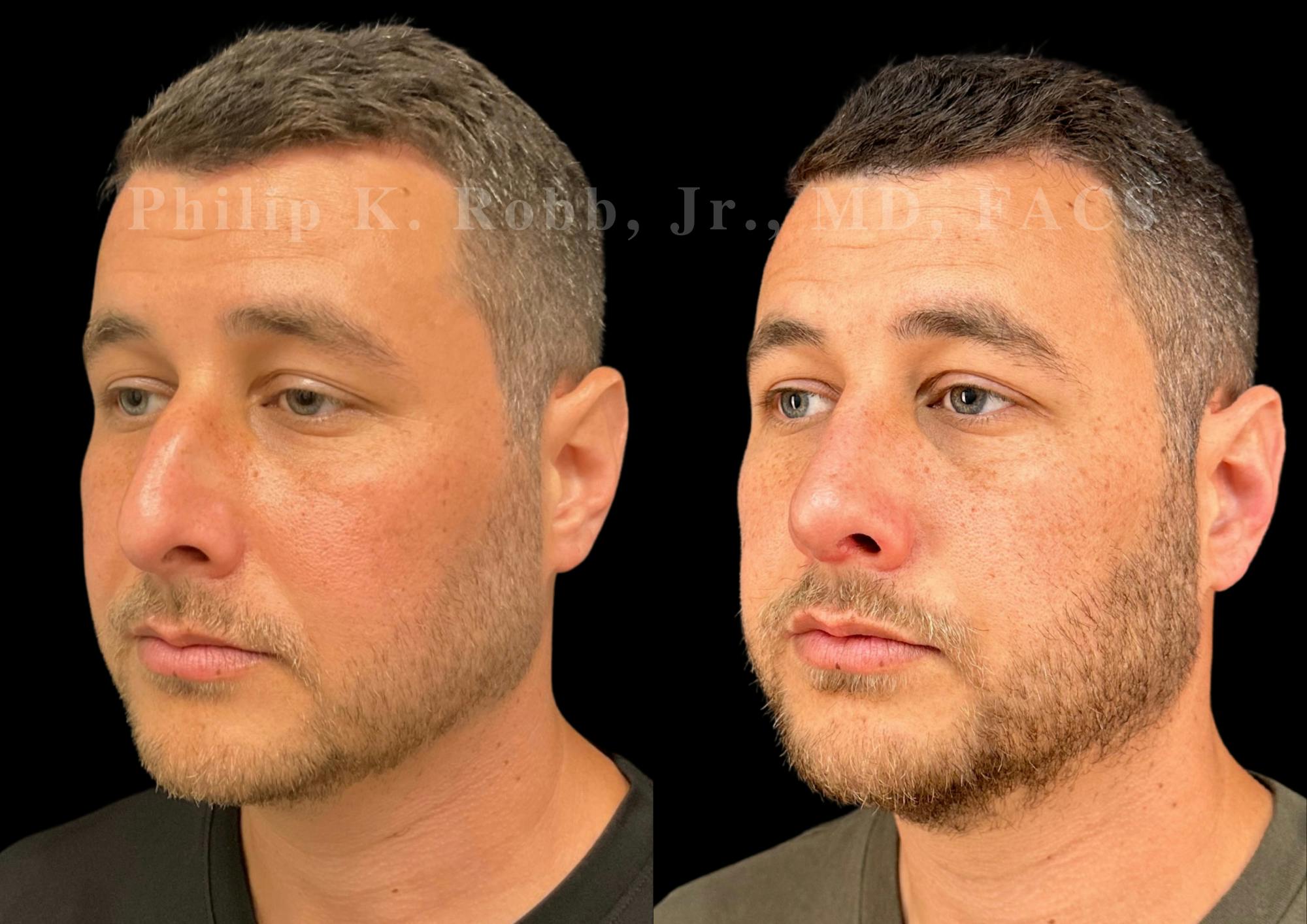 Ultrasonic Rhinoplasty Before & After Gallery - Patient 406620 - Image 4