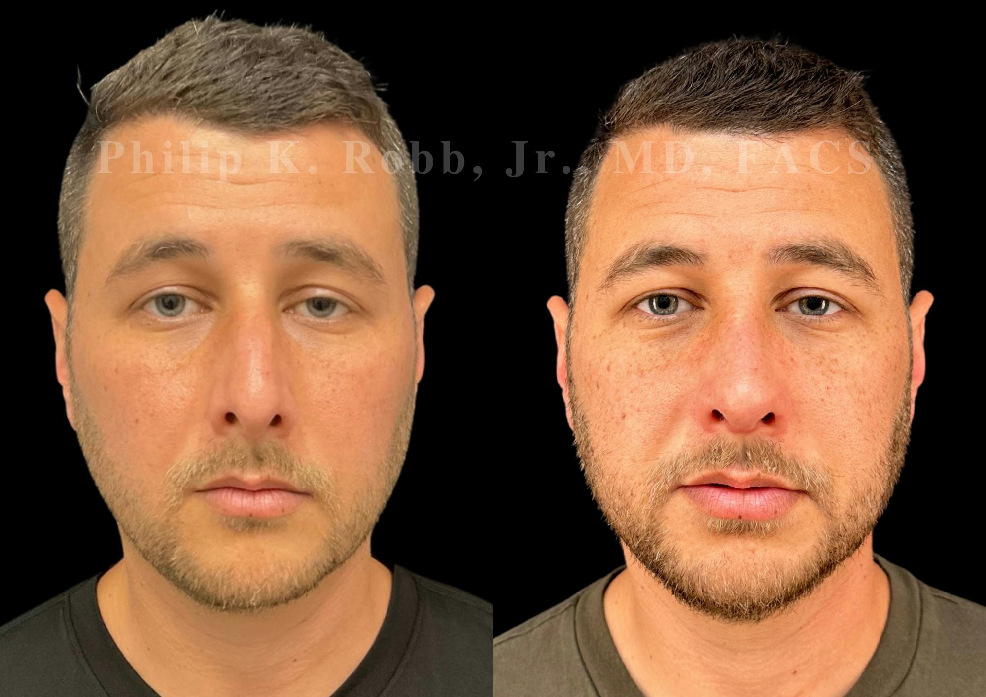 Ultrasonic Rhinoplasty Before & After Gallery - Patient 406620 - Image 3