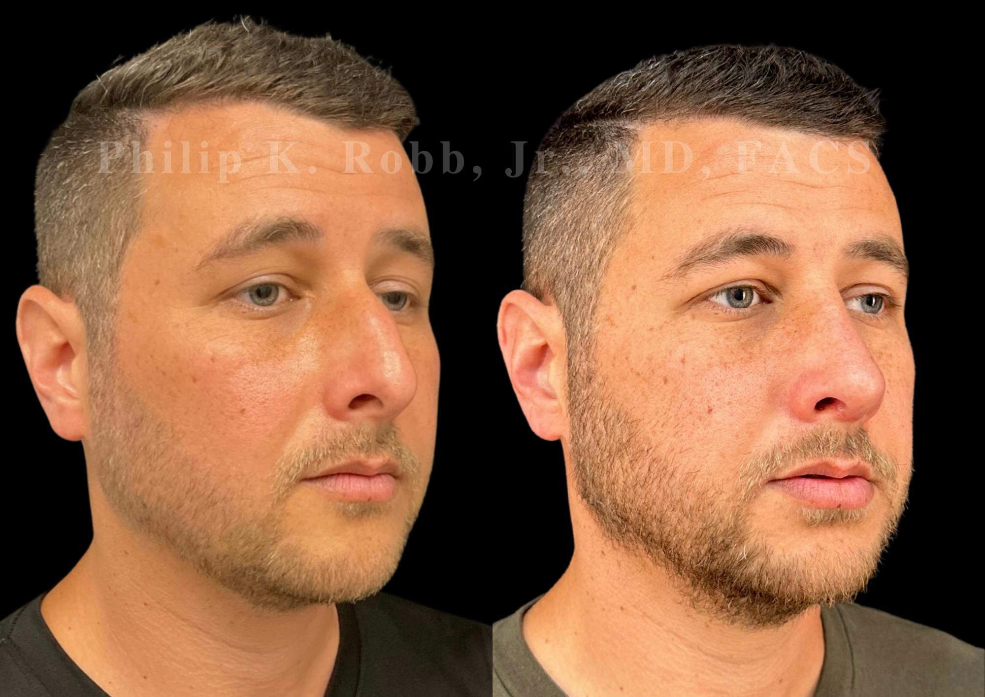 Ultrasonic Rhinoplasty Before & After Gallery - Patient 406620 - Image 2