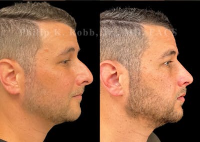 Ultrasonic Rhinoplasty Before & After Gallery - Patient 406620 - Image 1