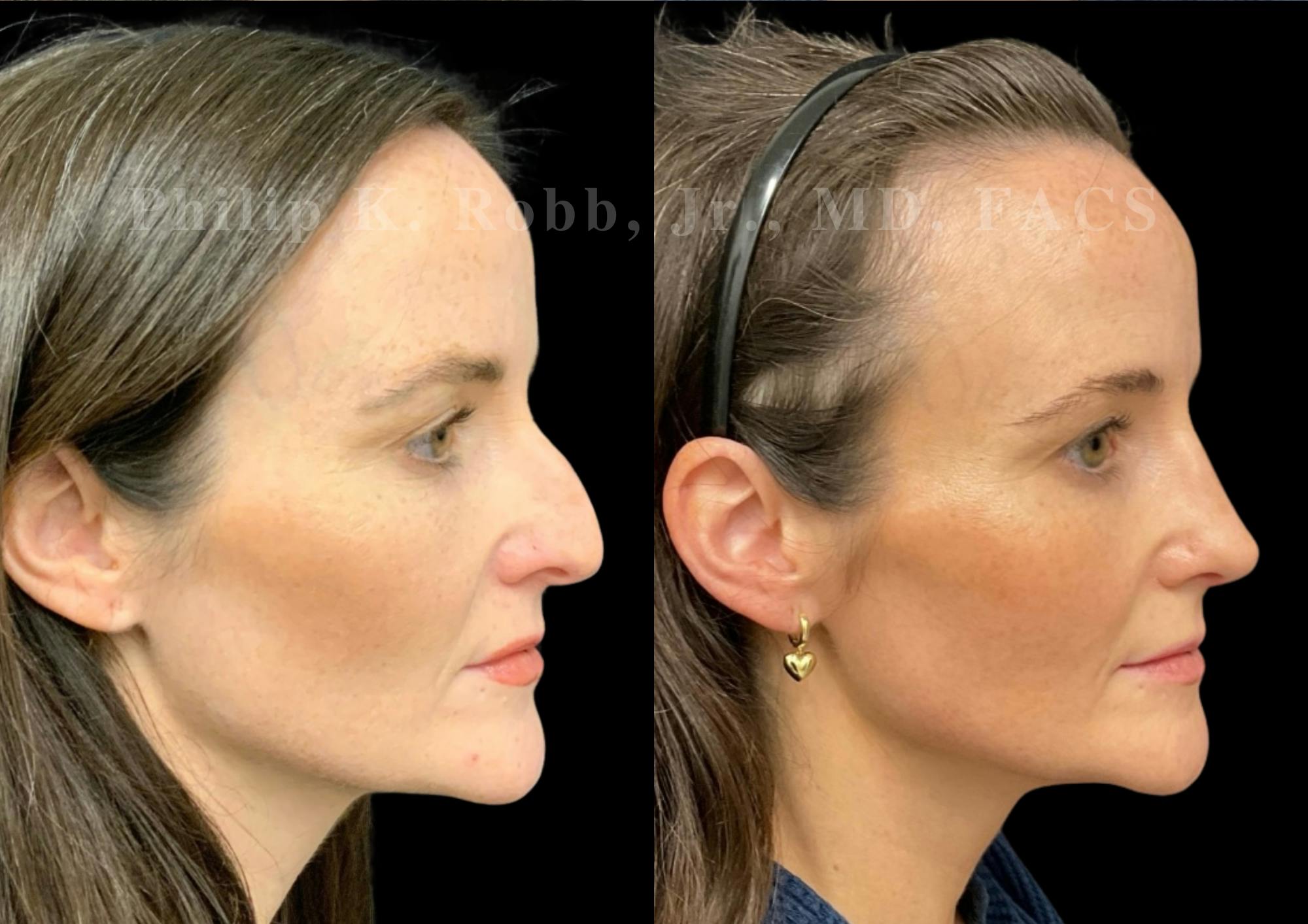 Ultrasonic Rhinoplasty Before & After Gallery - Patient 371758 - Image 1