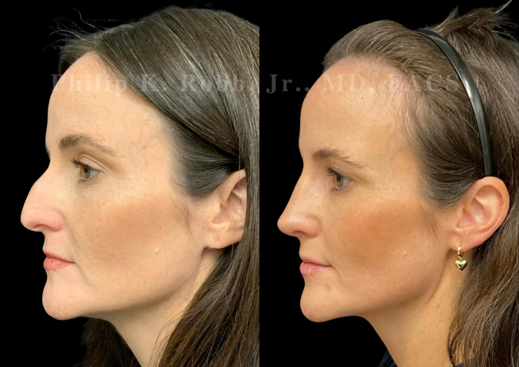 Ultrasonic Rhinoplasty Before & After Gallery - Patient 371758 - Image 5