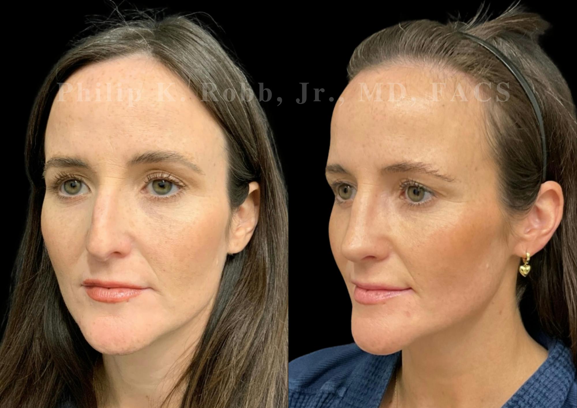 Ultrasonic Rhinoplasty Before & After Gallery - Patient 371758 - Image 4