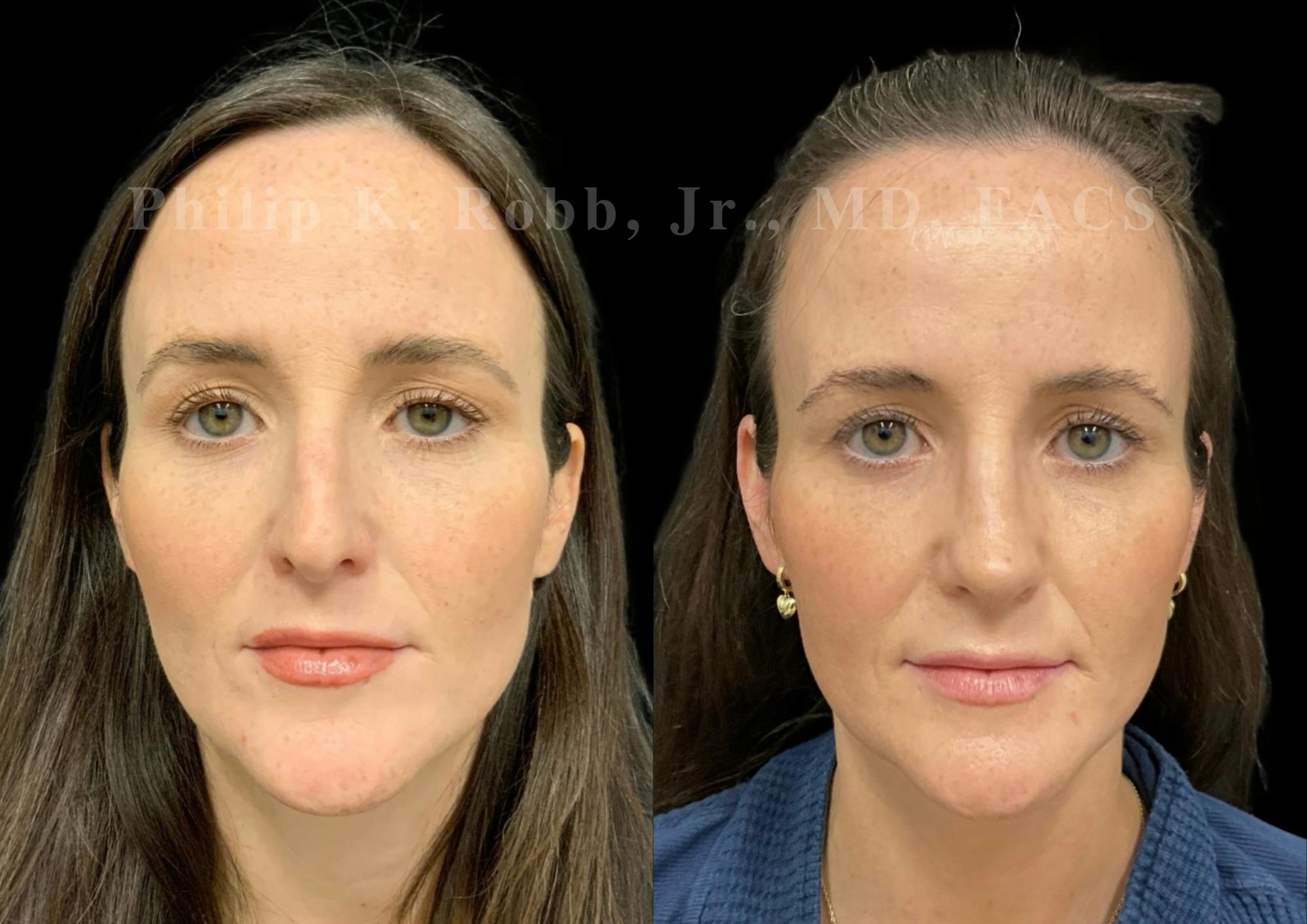 Ultrasonic Rhinoplasty Before & After Gallery - Patient 371758 - Image 3