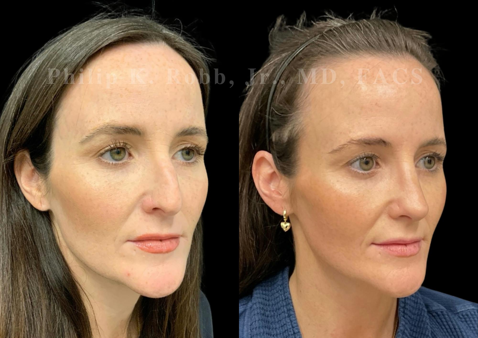 Ultrasonic Rhinoplasty Before & After Gallery - Patient 371758 - Image 2