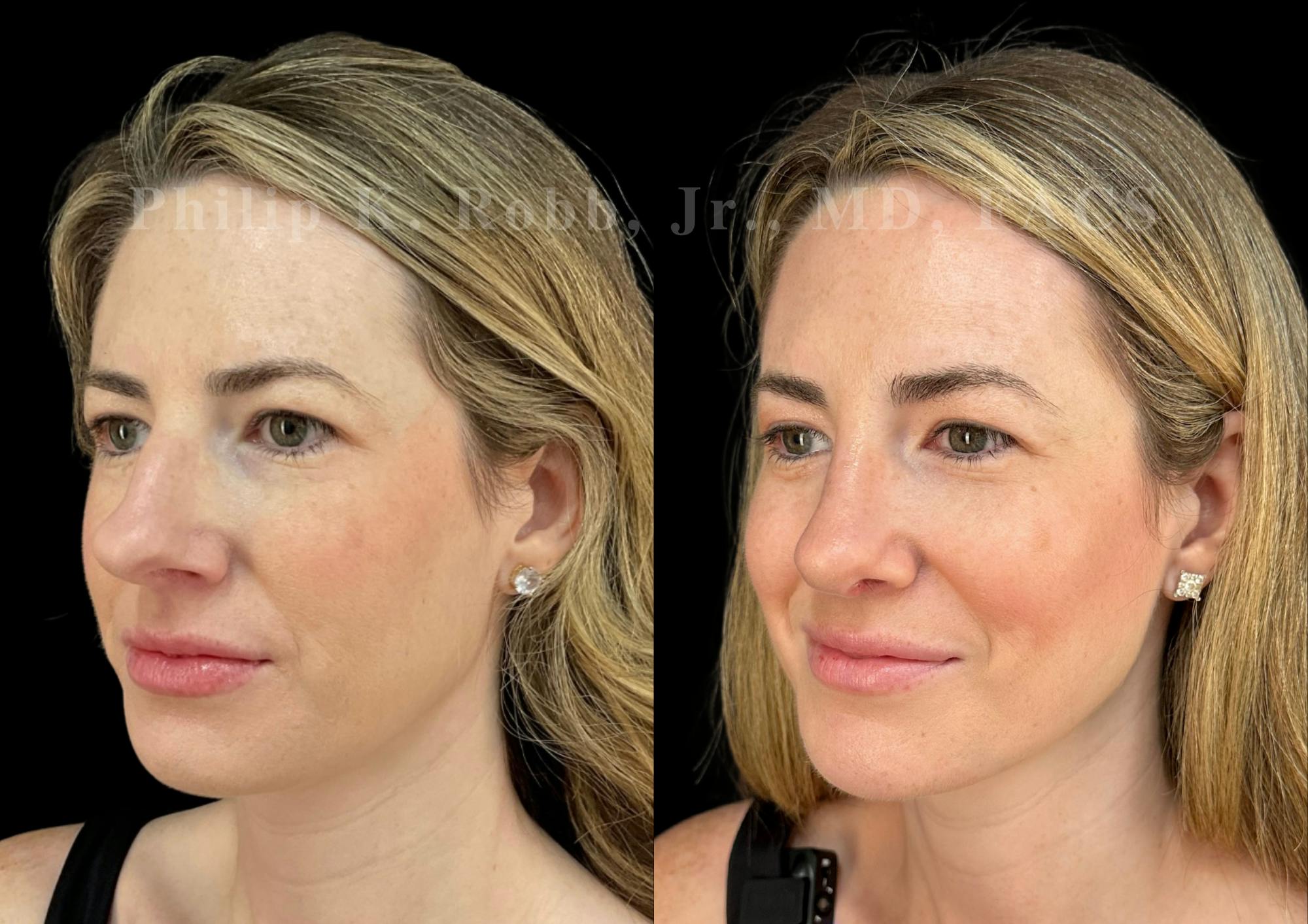 Ultrasonic Rhinoplasty Before & After Gallery - Patient 151963 - Image 4