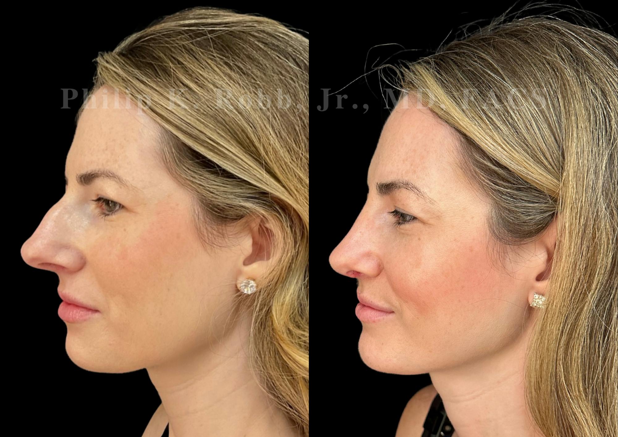 Ultrasonic Rhinoplasty Before & After Gallery - Patient 151963 - Image 5